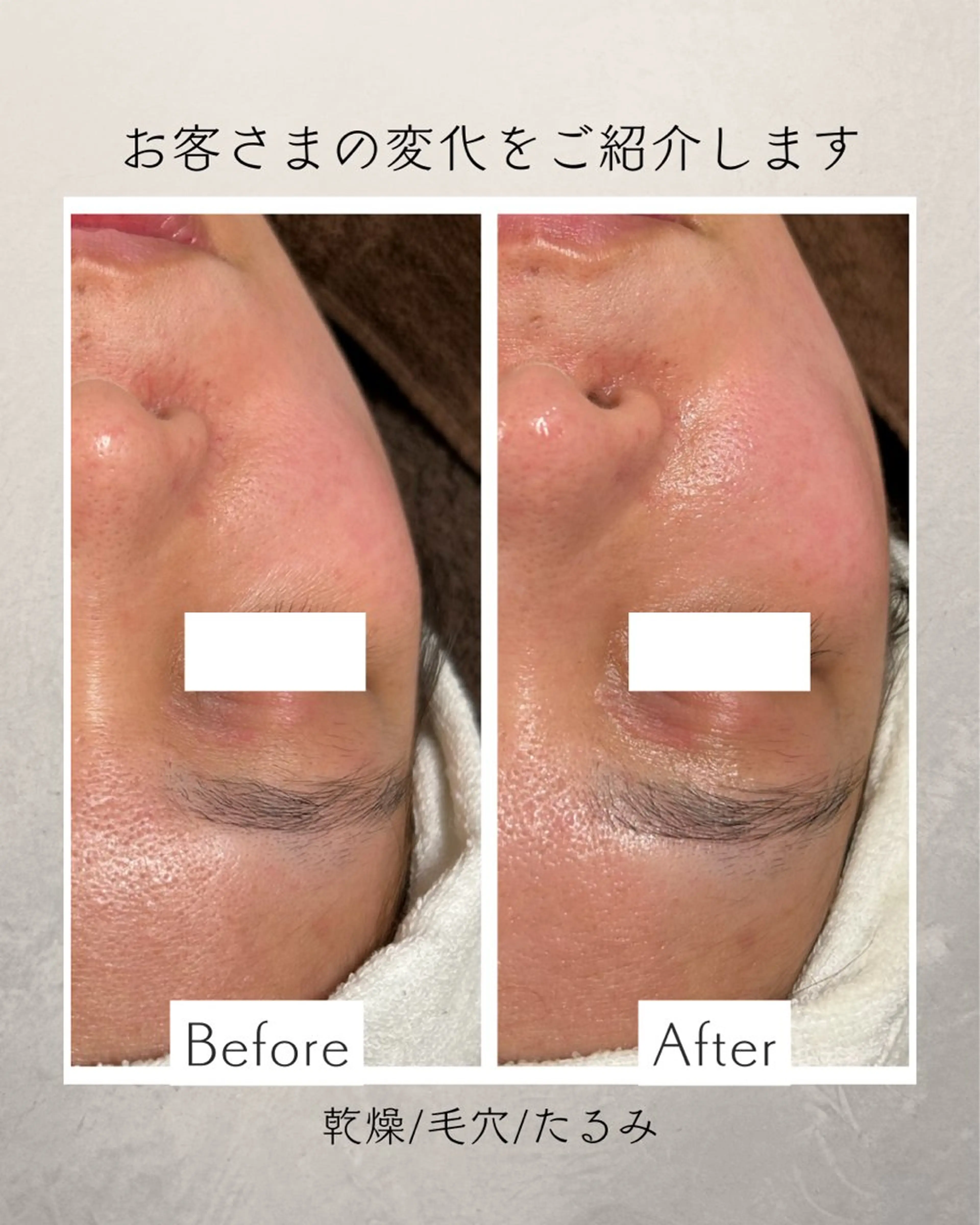 【40代の方】EMSでたるみ、ほうれい線を引き上げケア フェイシャルエステの写真