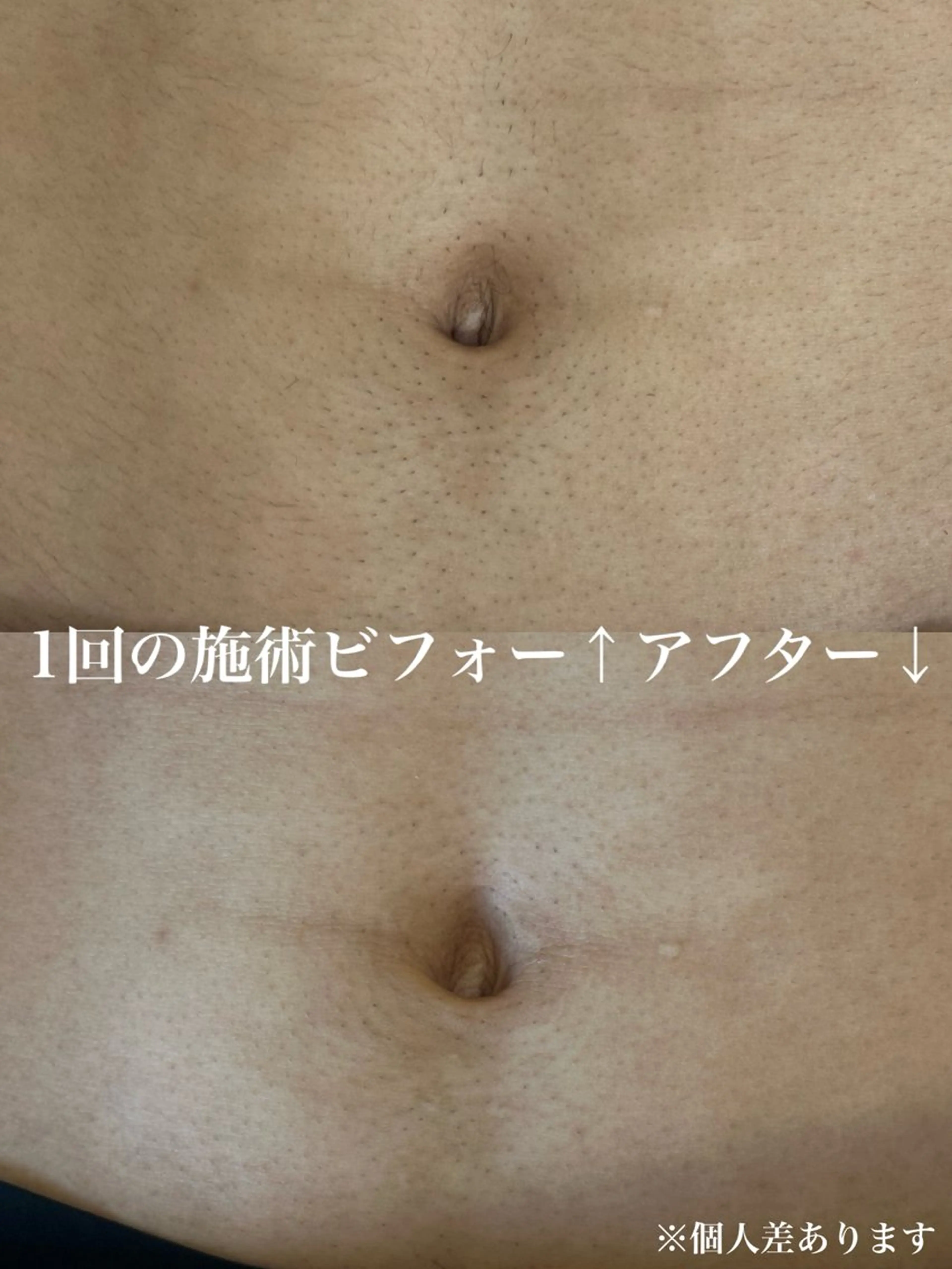 メンズ全身脱毛(ひげ全体＋VIO無し)の写真