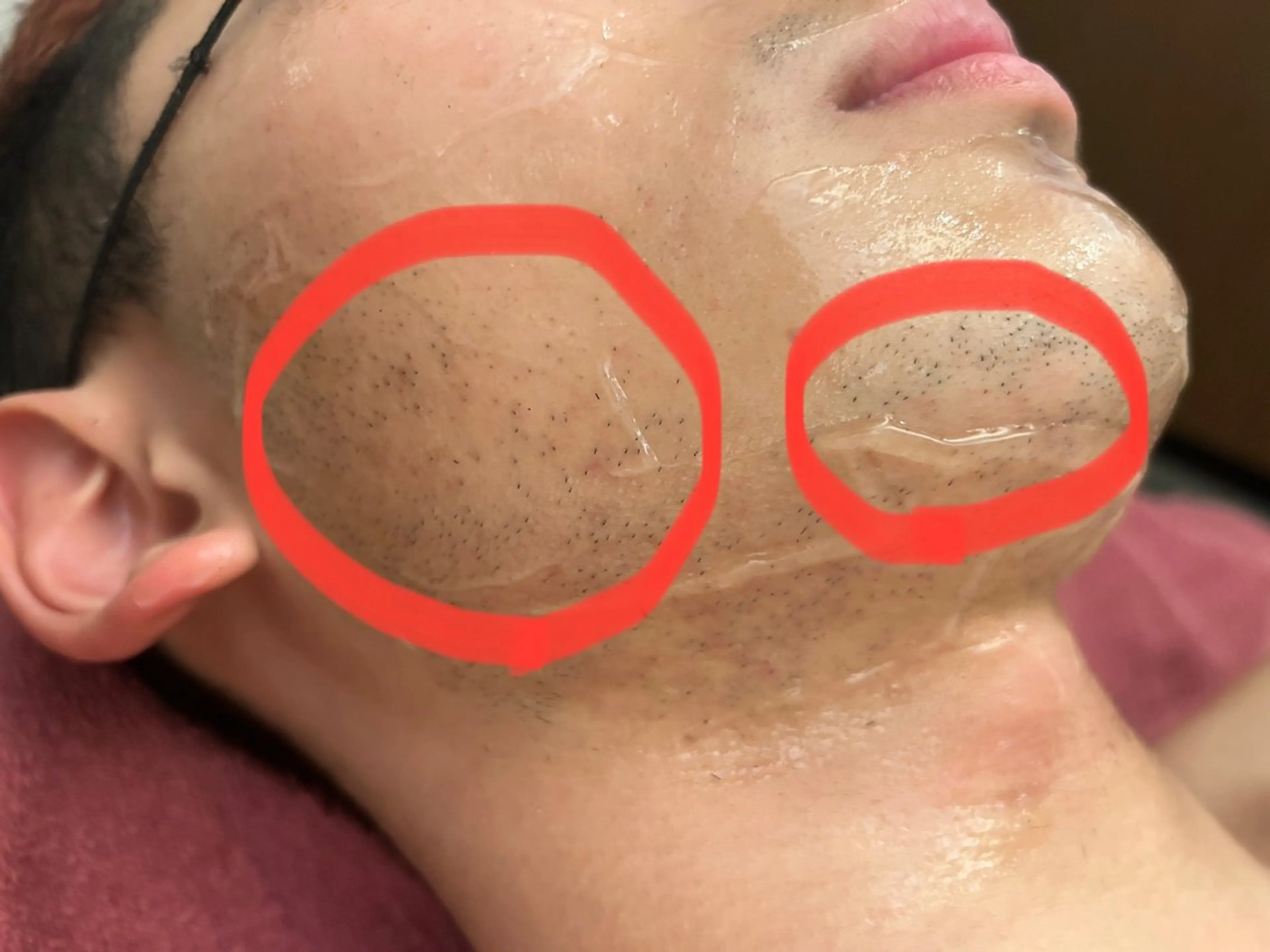 【メンズ】ひげ脱毛🥸の写真