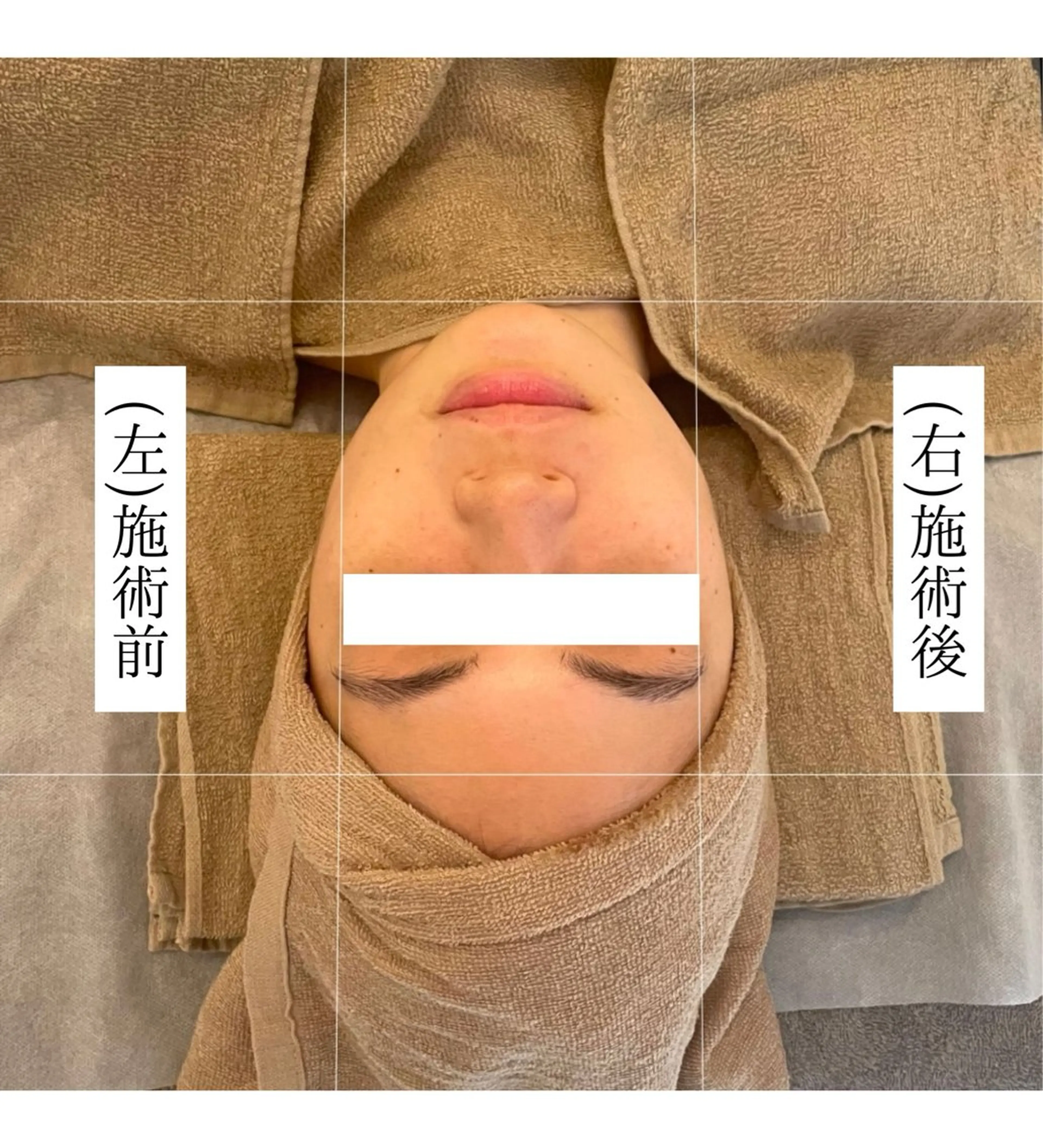 エステ 小顔/たるみ/黒ずみ除去専門サロン/SONA 大和西大寺店所属・【小顔専門看護師 サロンSONA】のエステ・リラクイメージ