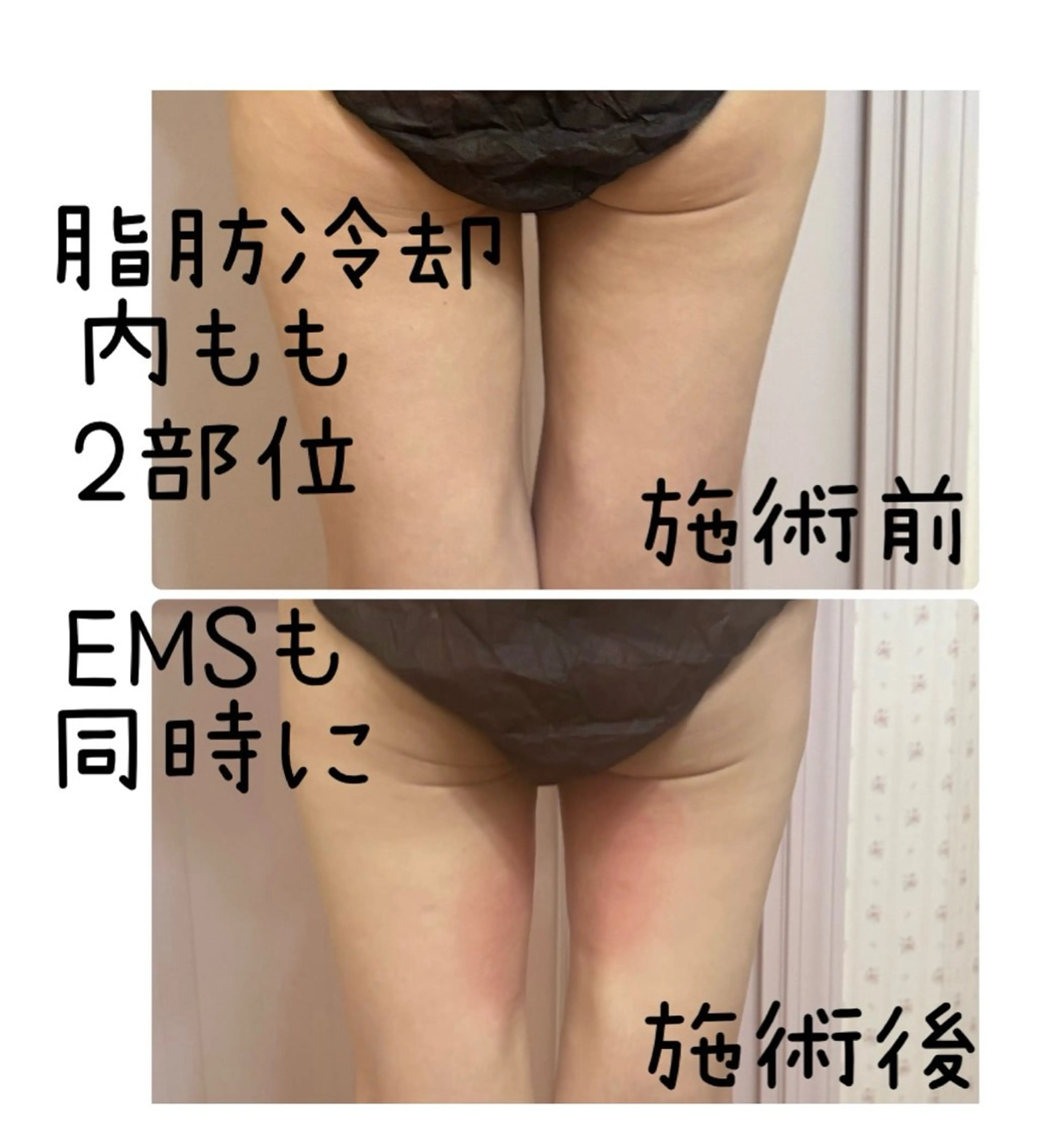 お試し冷却スリミングケア2部位の写真