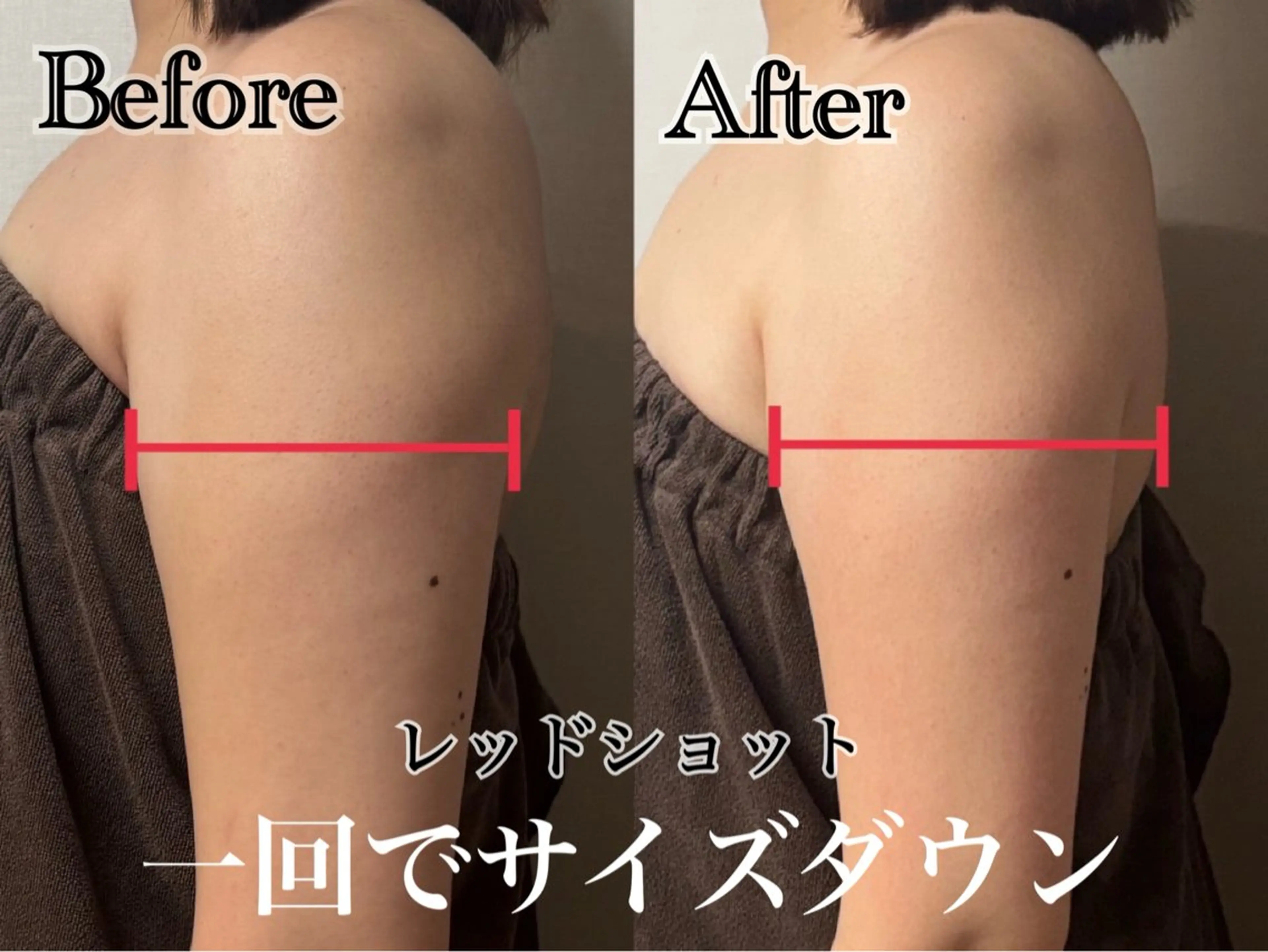 【レッドショット導入価格✨】韓国発🇰🇷最新美容脂肪撃退💉🩸二の腕またはお腹3cc導入❤️‍🔥EMSラジオ波付きの写真