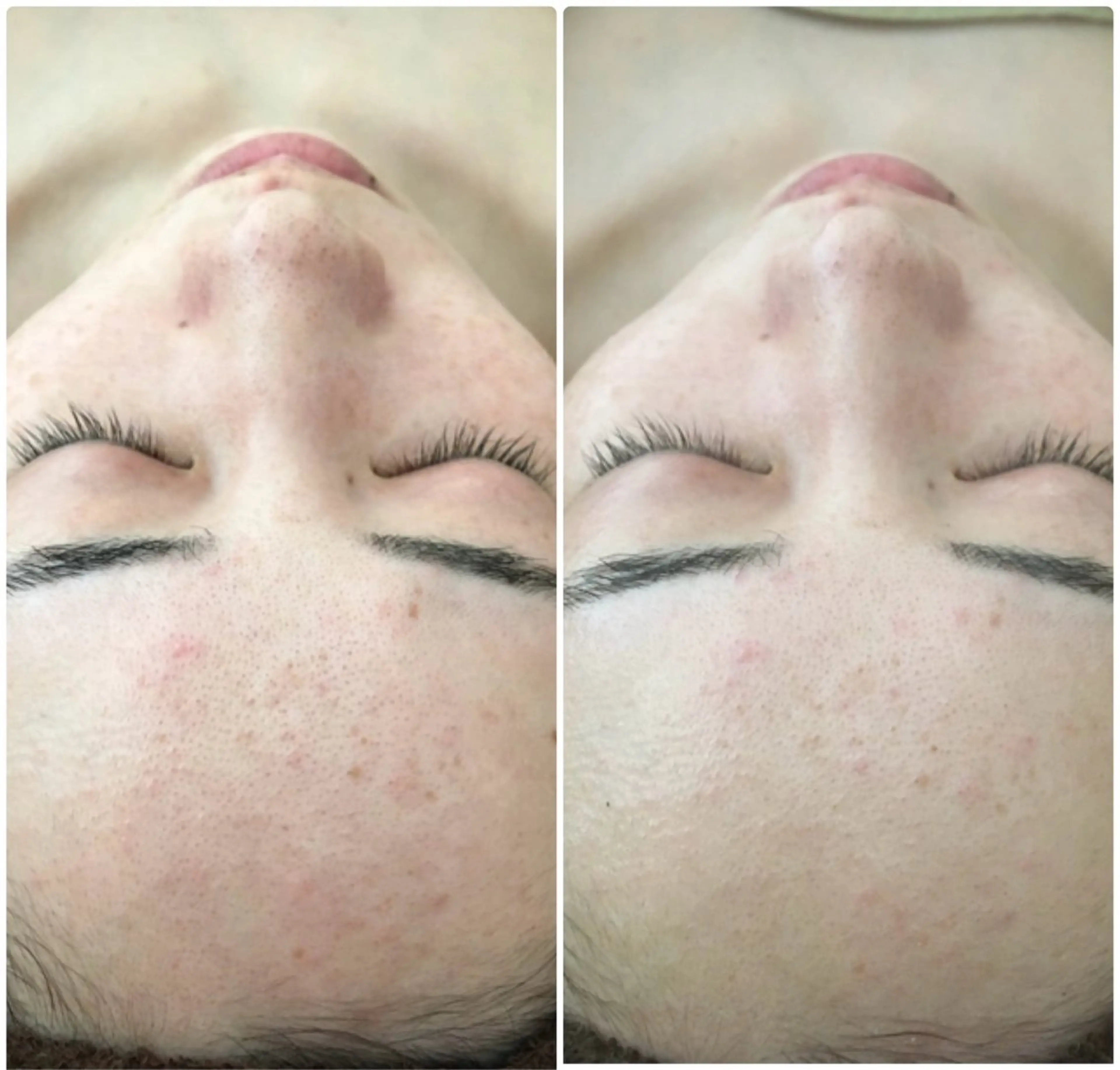 エステ SILOE【ハーブピーリング/REVI/ニキビ/シミ/シワ/毛穴ケア】所属・【SILOE】 ハーブピーリングのエステ・リラクイメージ