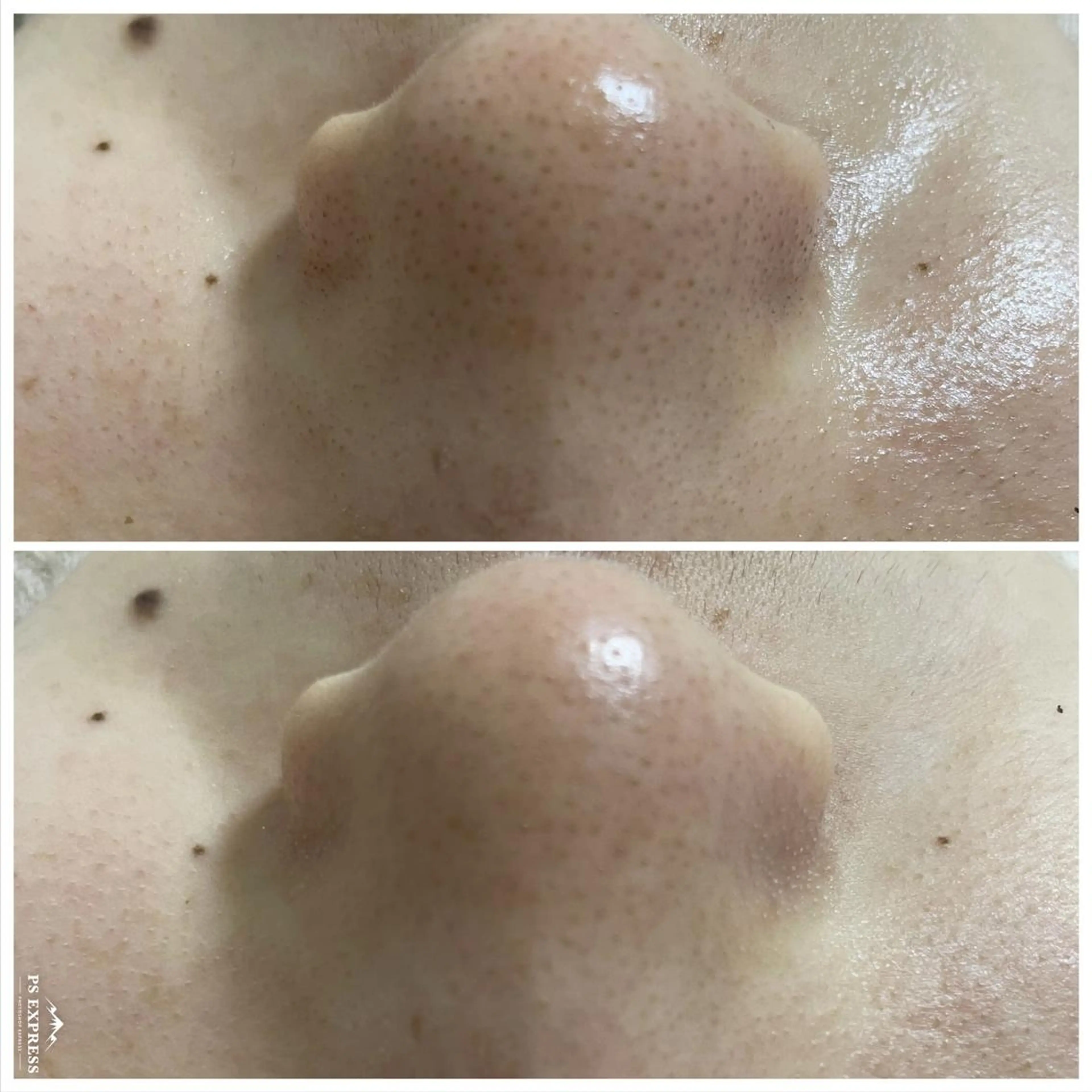 ニキビ・毛穴改善 🌿ハーブピーリングのエステ・リラクイメージ