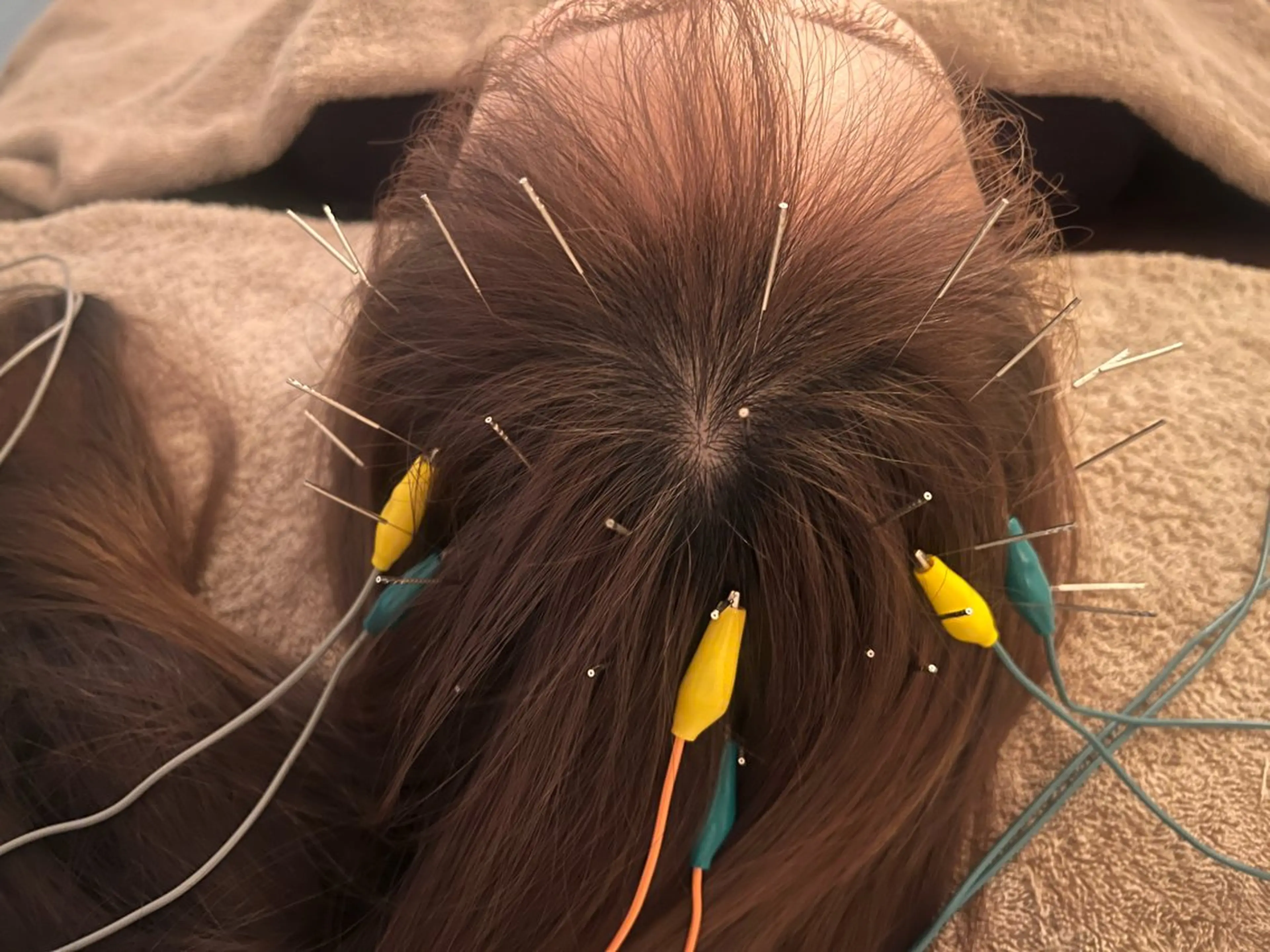 NEW【頭のサイズや張りに効く】 頭皮電気鍼x頭蓋骨リフトスペシャル40分の写真