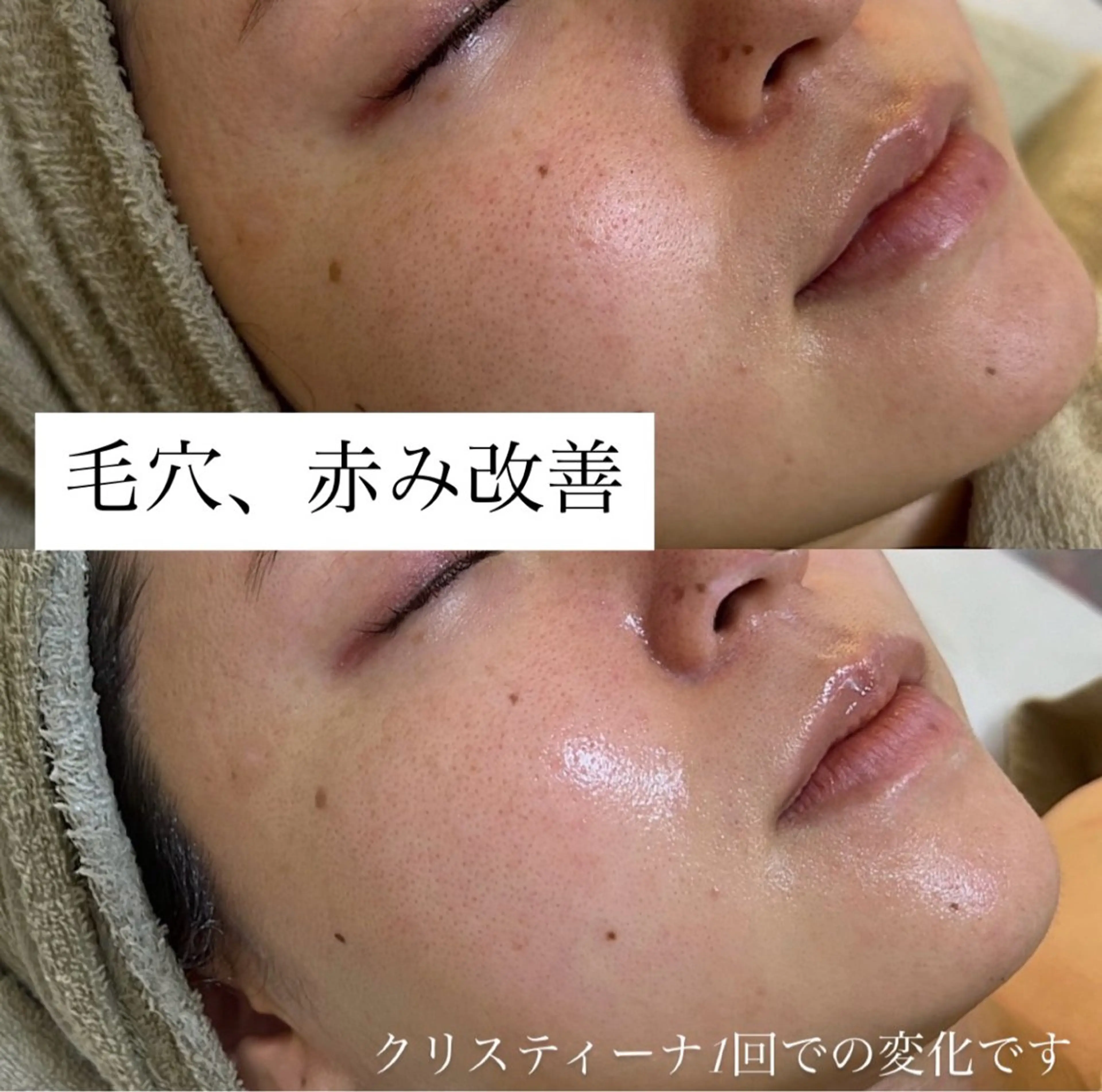 肌質改善専門サロンAte国分寺店所属・Ate Rikaのエステ・リラクイメージ