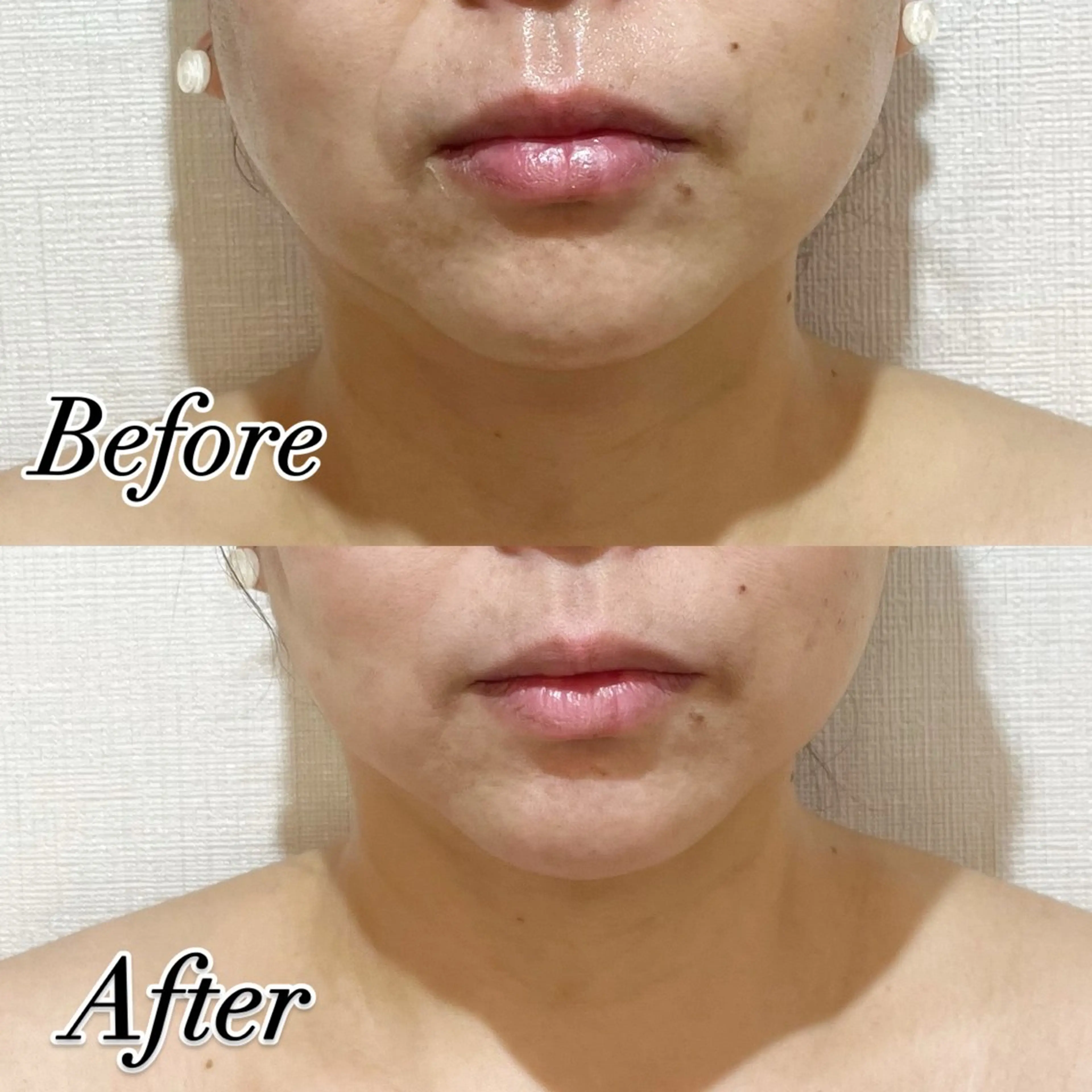 🌹たるみケアコース🌹の写真