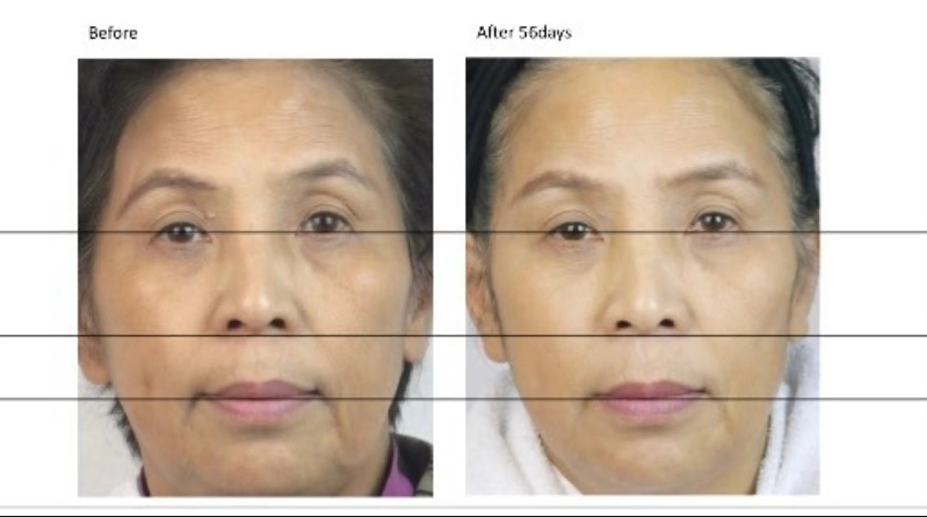 小顔ハイリフトアップ目の周りのシワ乾燥肌コラーゲン補給女優肌　ヒト幹細胞炭酸パックは有名女優さん使っていますの写真