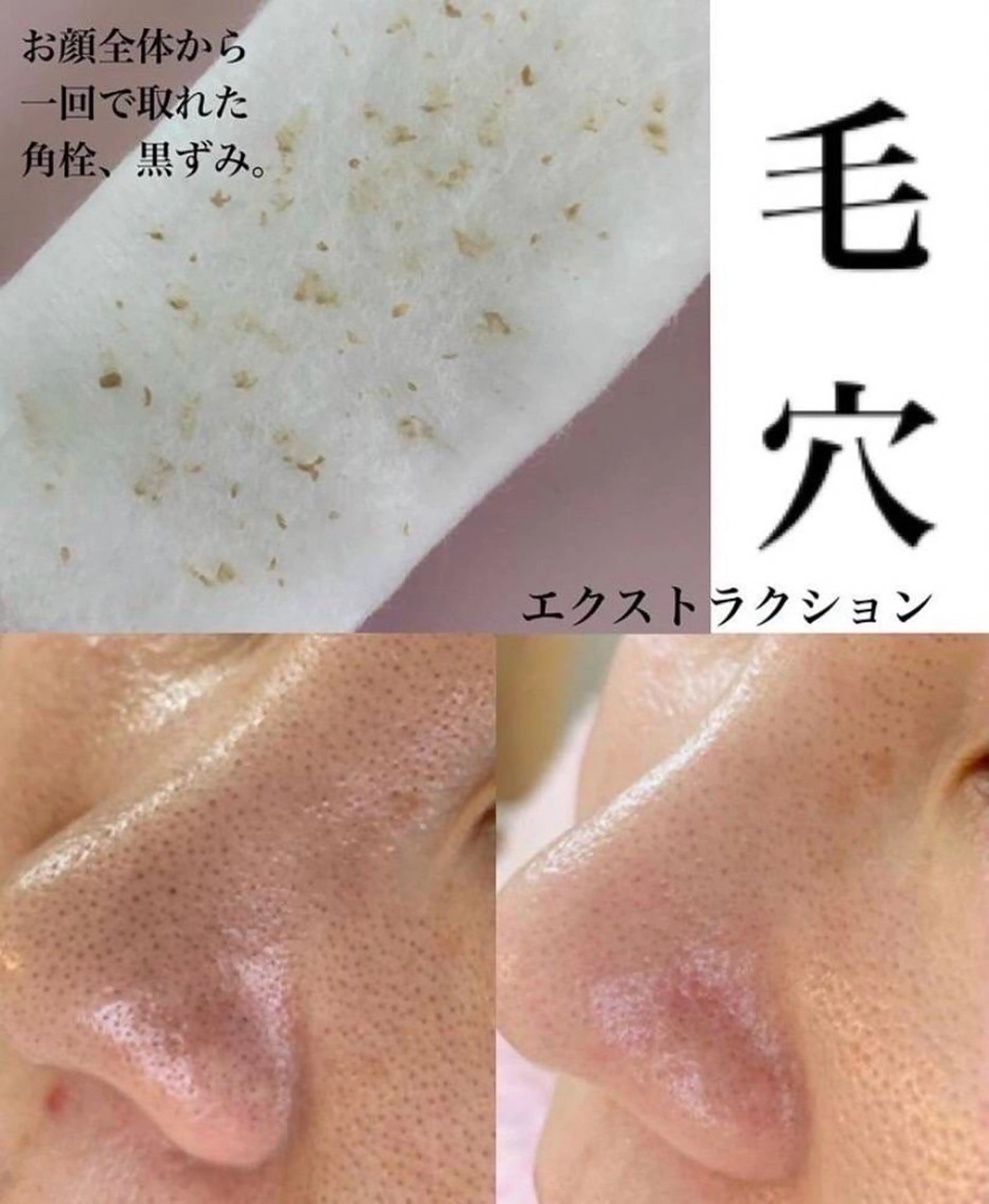 毛穴エクストラクションの写真