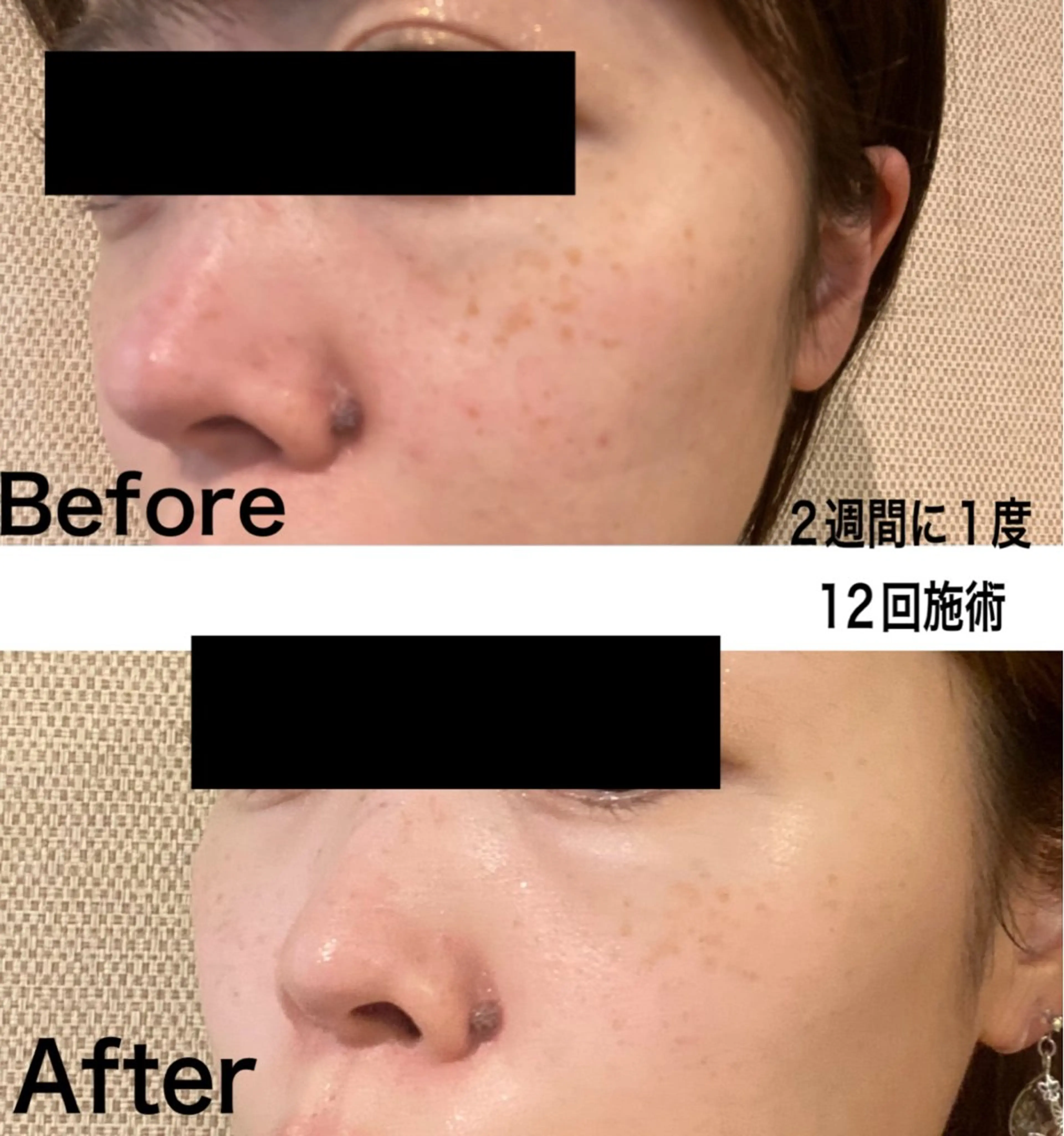 【男女OK】光フェイシャル＋ホワイトパック＋シェービング¥6500→¥3300 ※口コミ投稿必須の写真