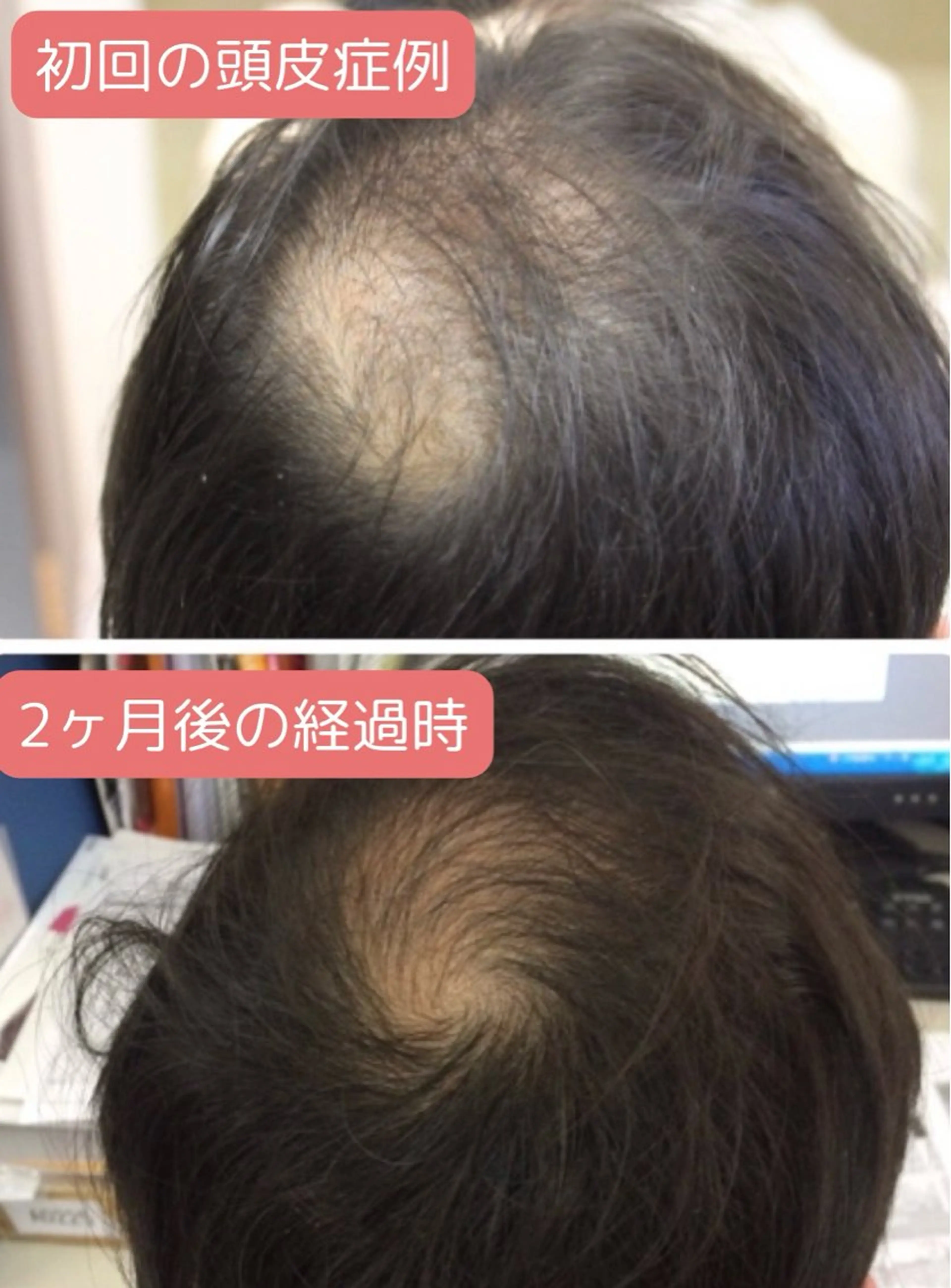 【育毛／発毛】薄毛が気になる方へ。まずは無料カウンセリングにお越しください。の写真