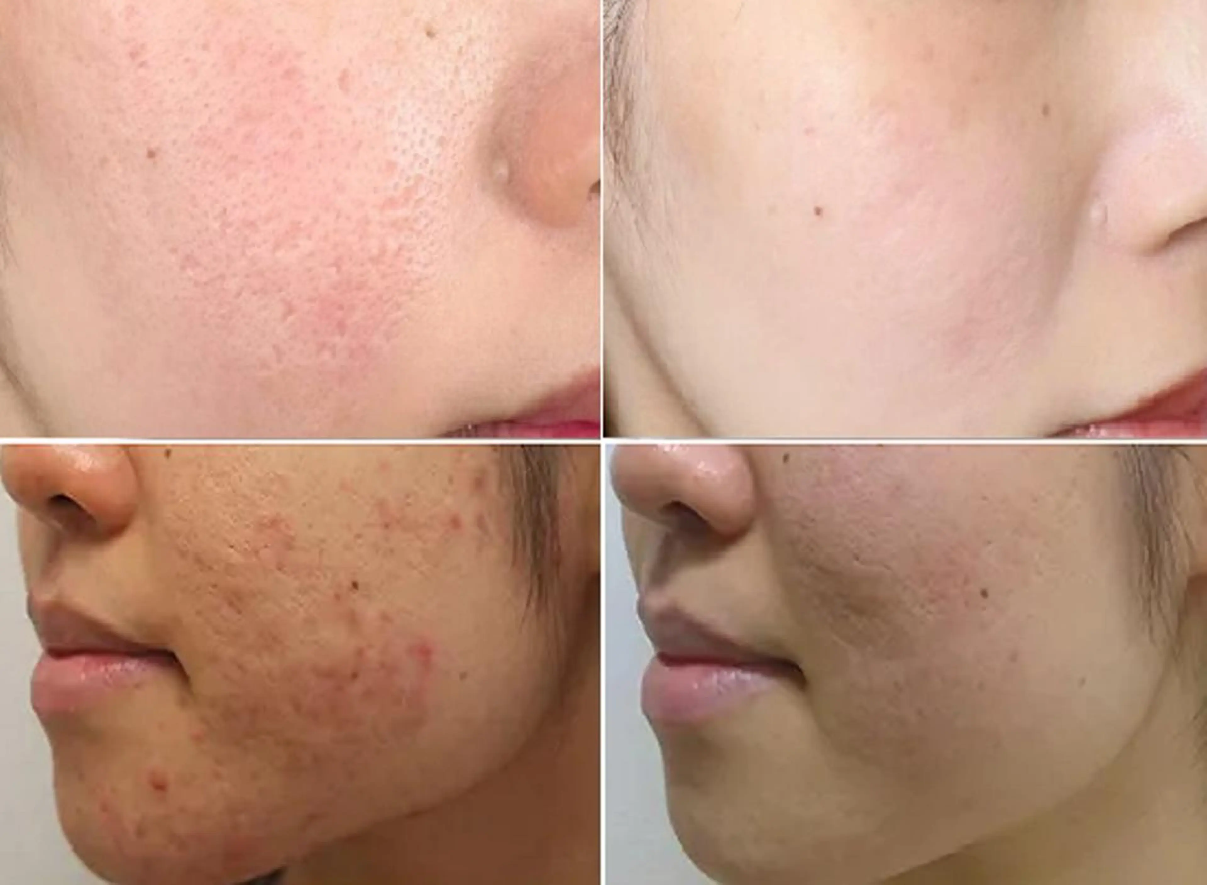 【美容顔脱毛】+【肌荒れケア】エステ唯一の抜けと美肌&4種の美容特許フェイシャルで肌修正の写真