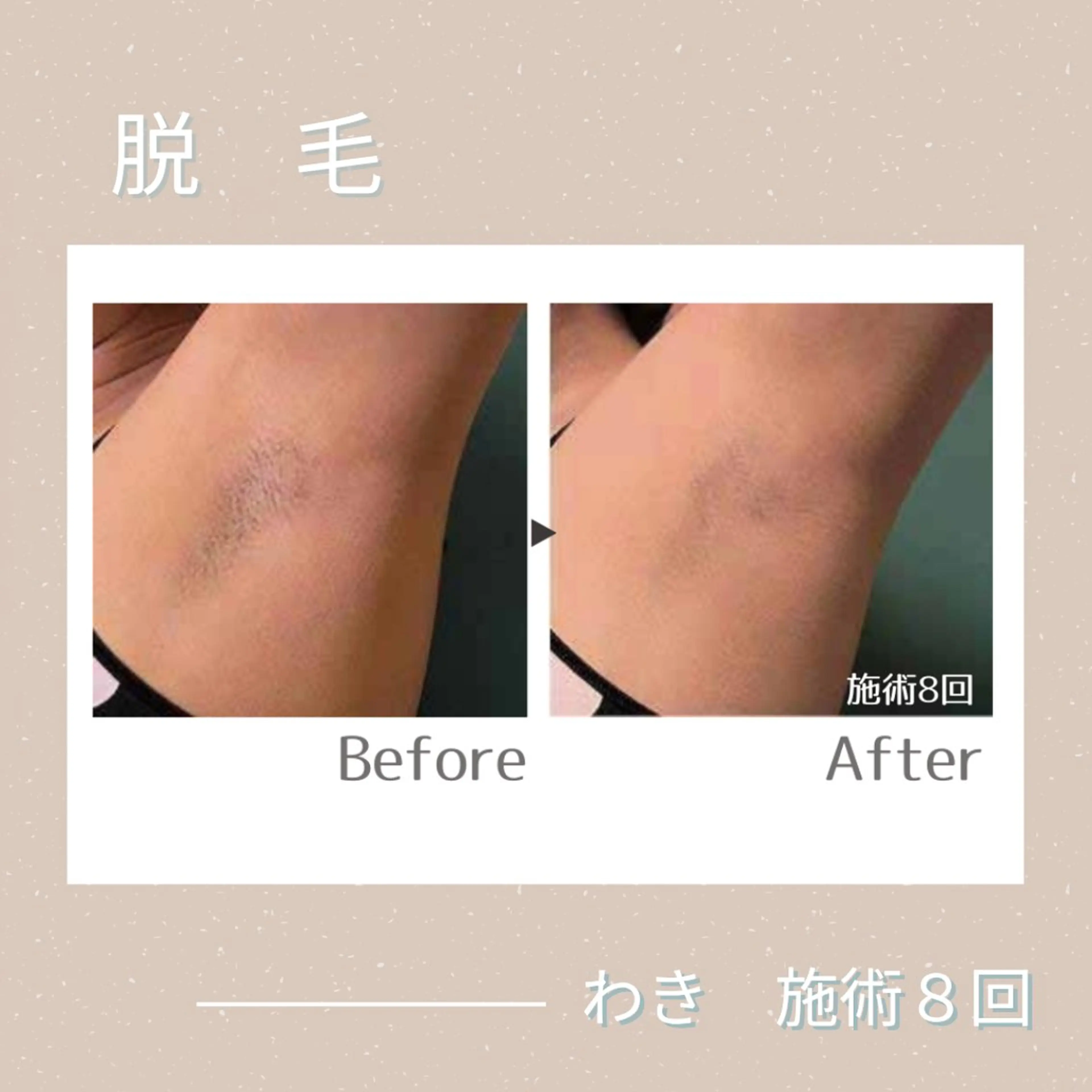 メンズ キッズ 脱毛 ainoa所属・ainoa アイノアのエステ・リラクイメージ