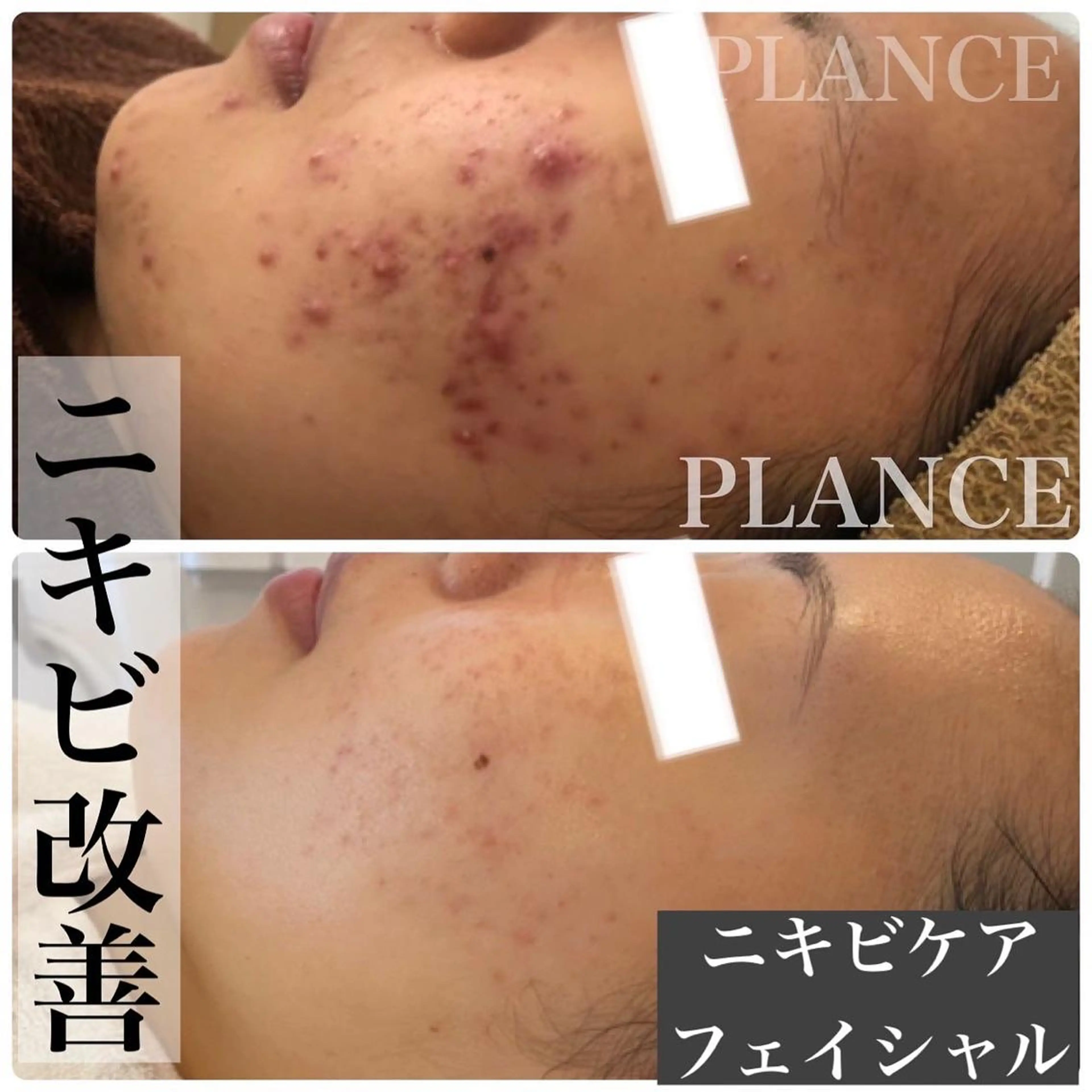 エステ フェイシャル専門 肌質改善/プランスのエステ・リラクイメージ