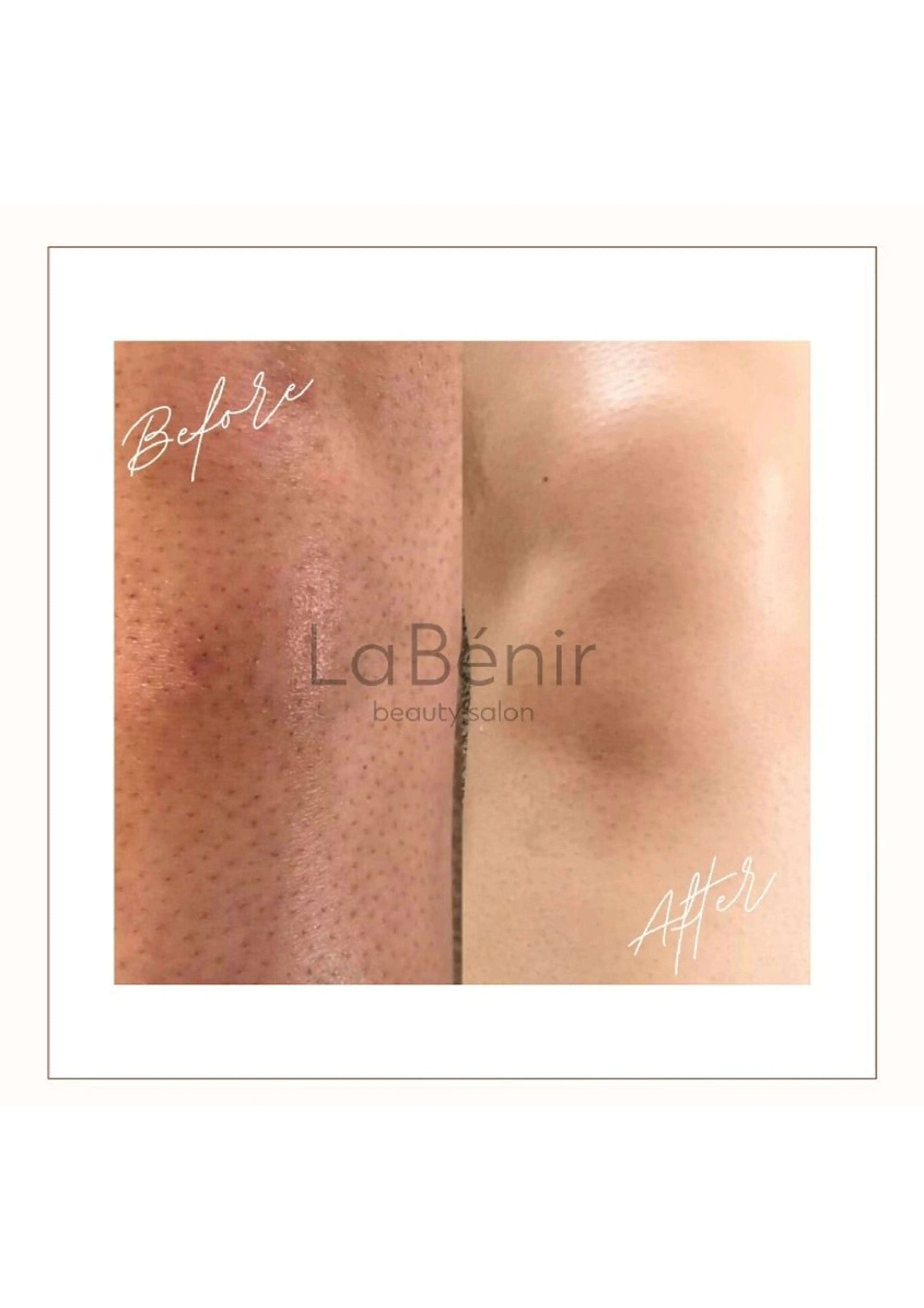 メンズ 脱毛 脱毛/美肌【皮膚科看 護師経営】ラベニールのエステ・リラクイメージ