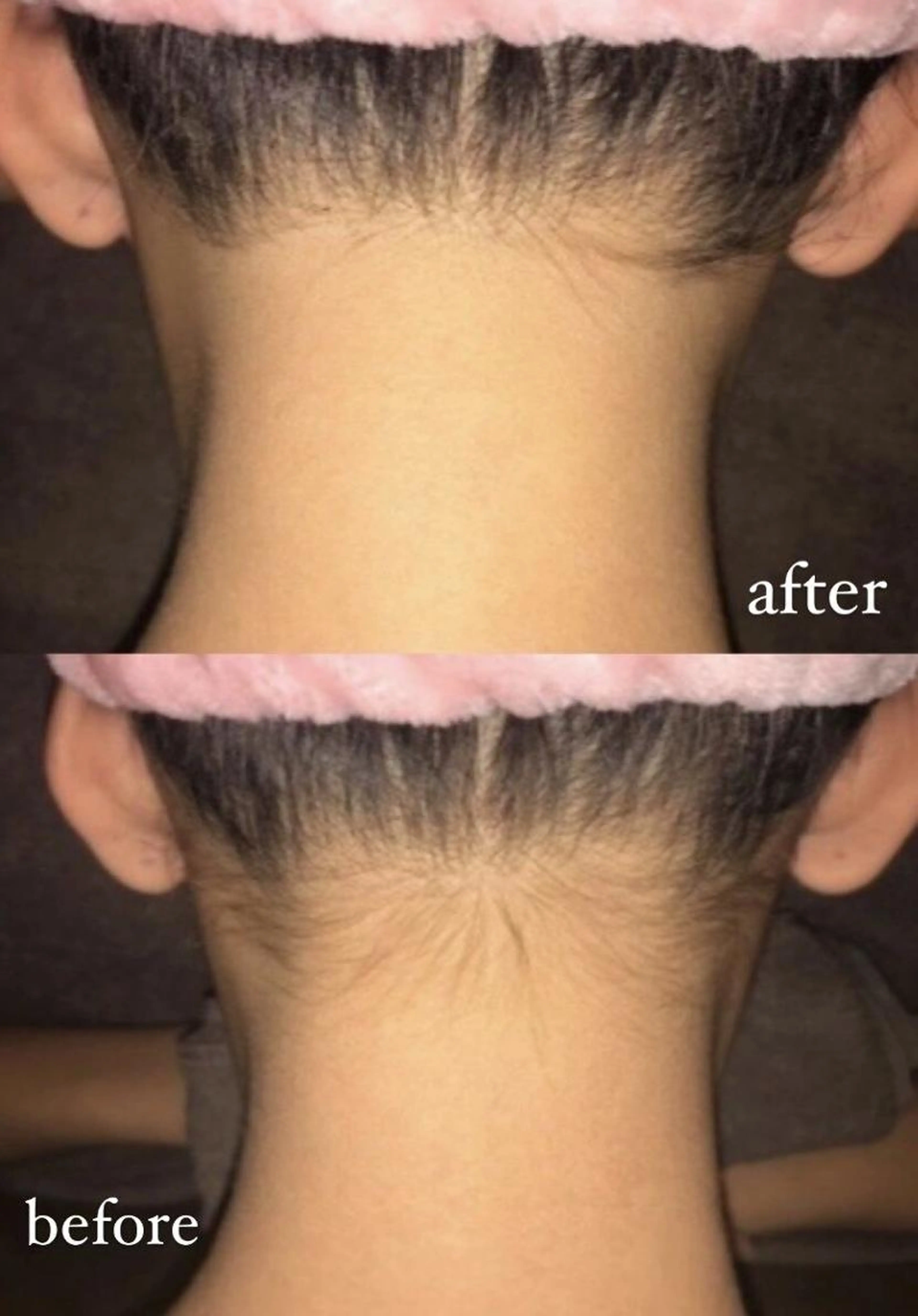 【お試し価格】えりあし・うなじ脱毛通常¥4,950→¥1,650の写真