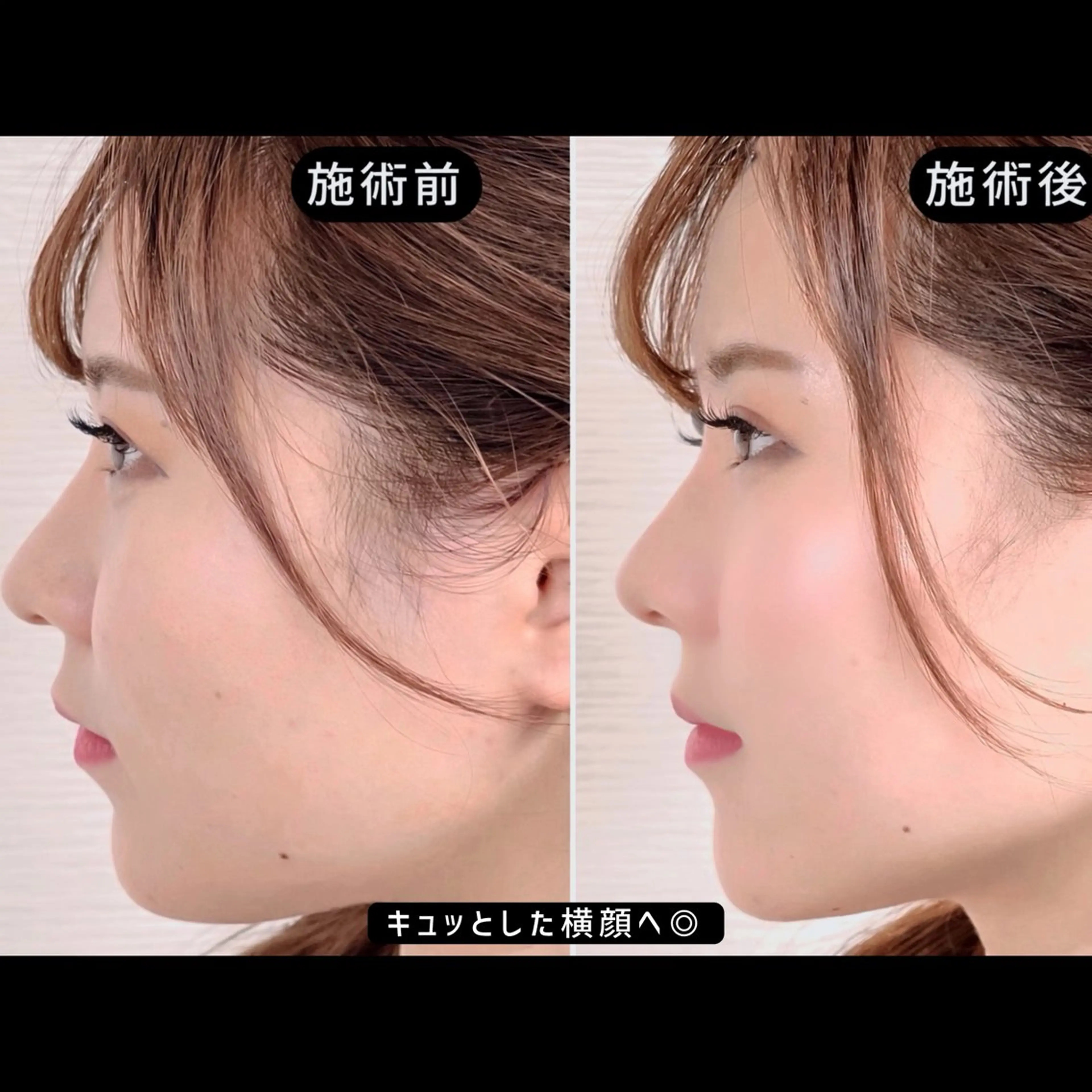 【迷ったらこのメニューでOK】EMS美容鍼 60分の写真