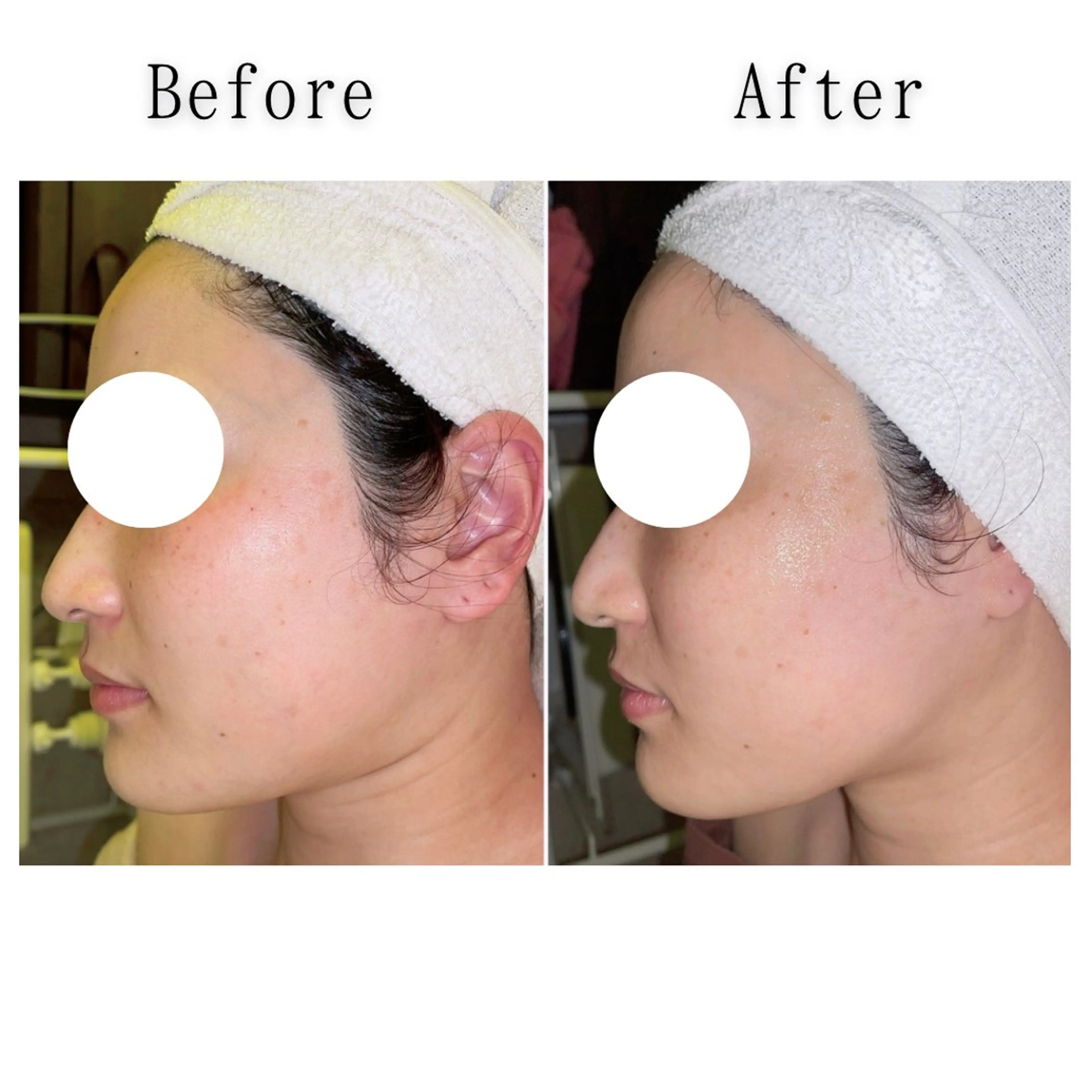 【ほうれい線/目下のたるみ/フェイスライン改善】の写真