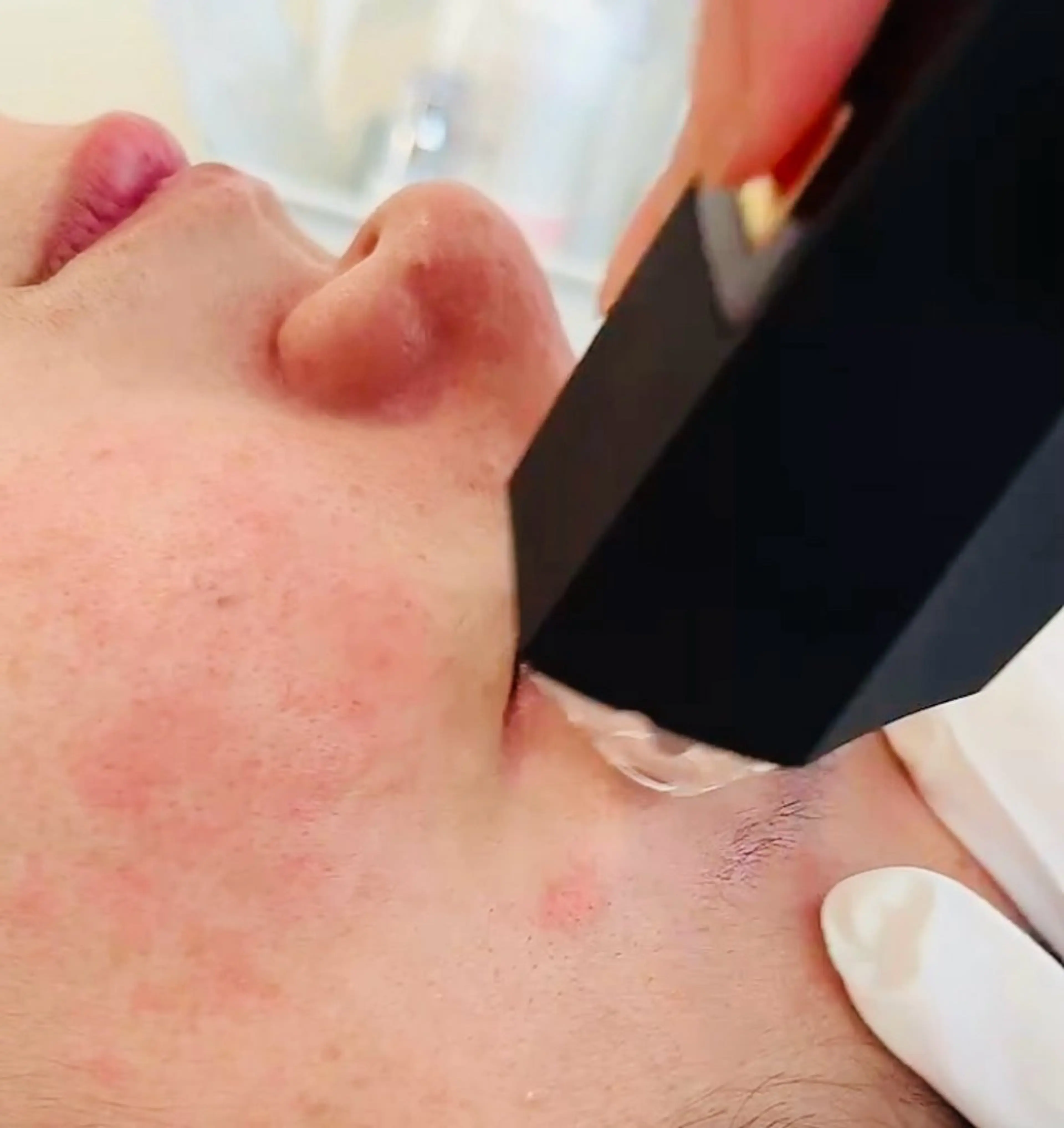 プラズマニードルの写真