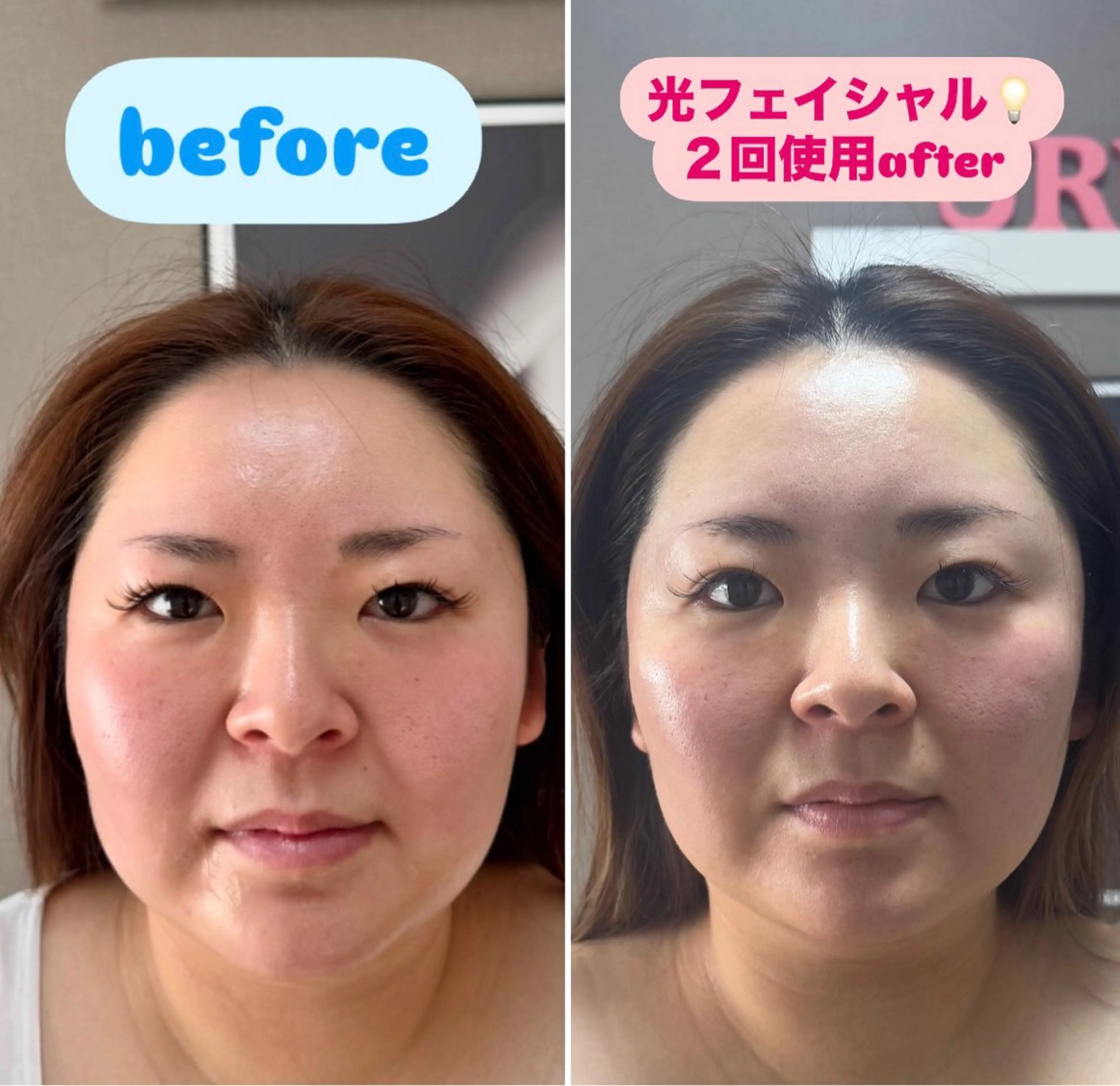 光フェイシャルの写真