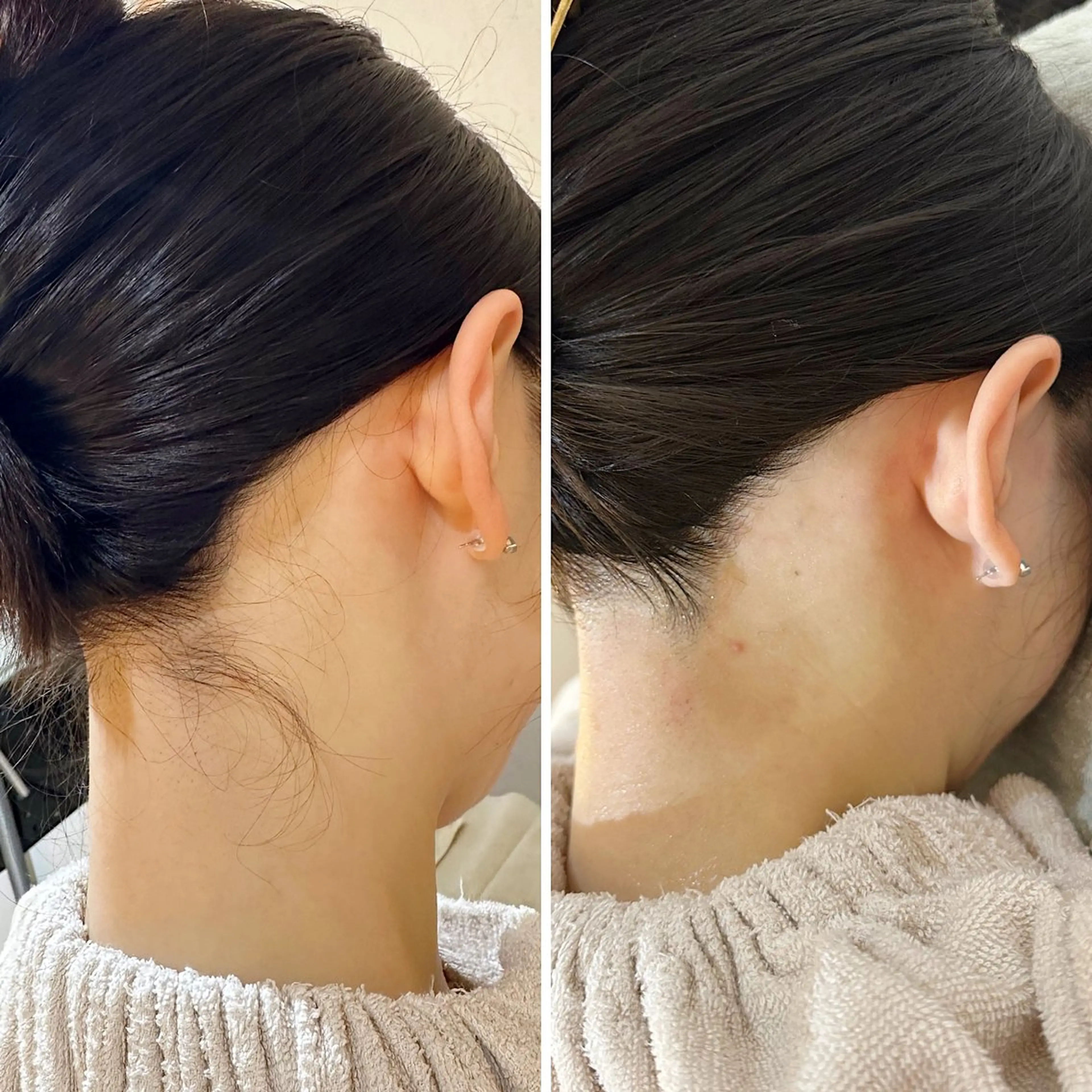 脱毛 うなじ脱毛/美肌脱毛 LABELのエステ・リラクイメージ