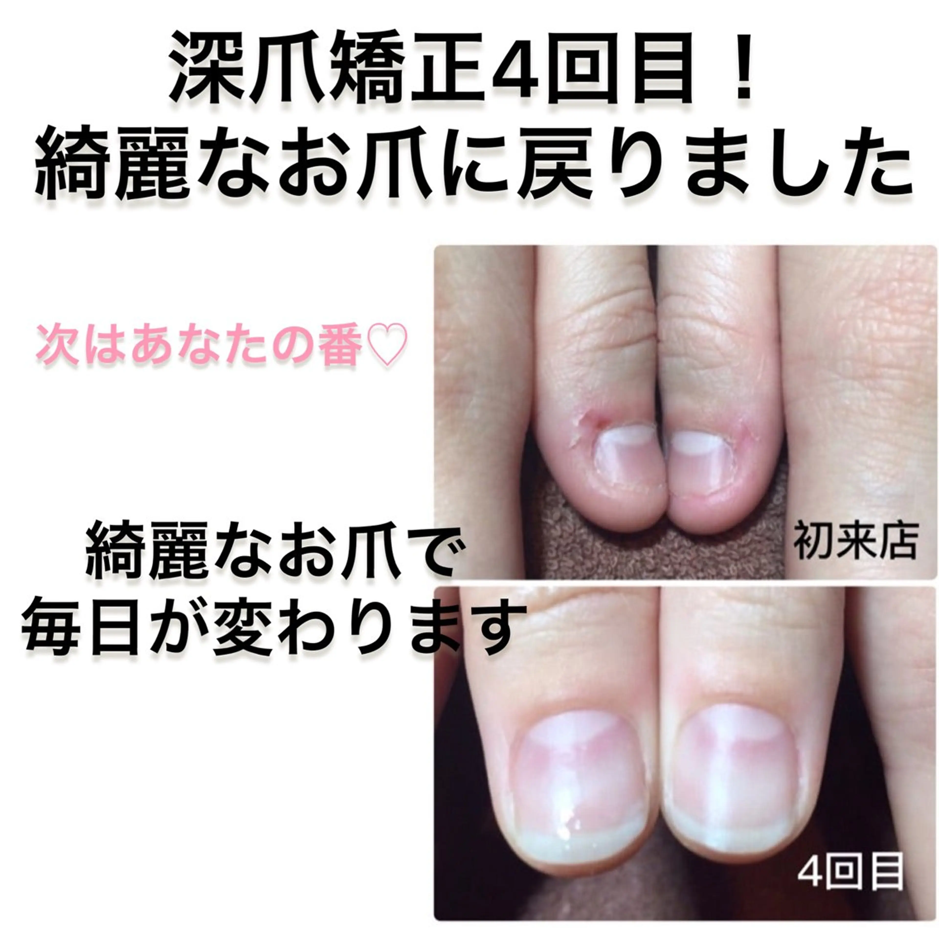 深爪矯正🎀長年の悩みはここで解消🙌の写真