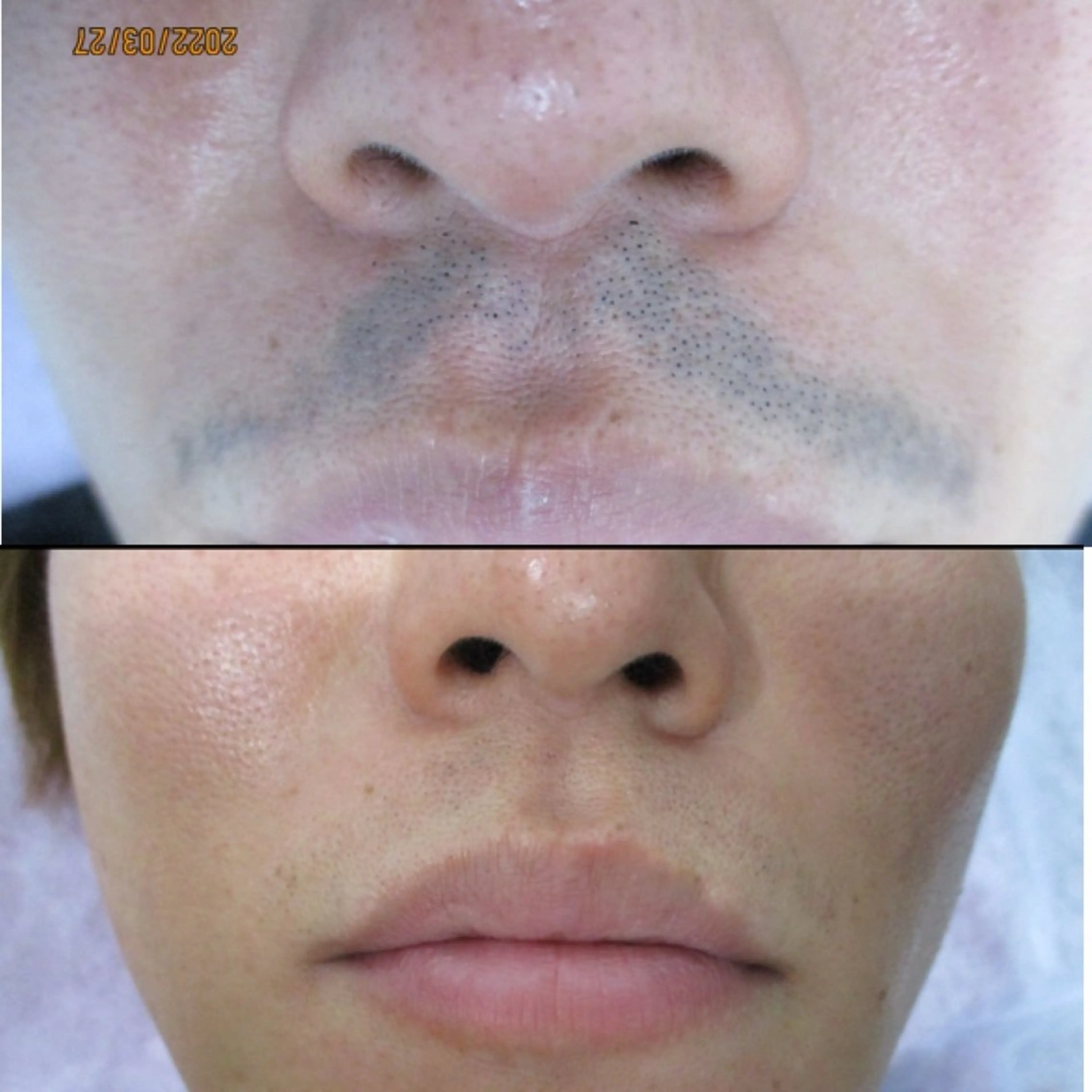 メンズ大学生以下限定🫧【ヒゲ脱毛2回】見た目、ニキビ肌もキレイに♪最新IPLxSHR光脱毛で痛みが少なく効果◎の写真