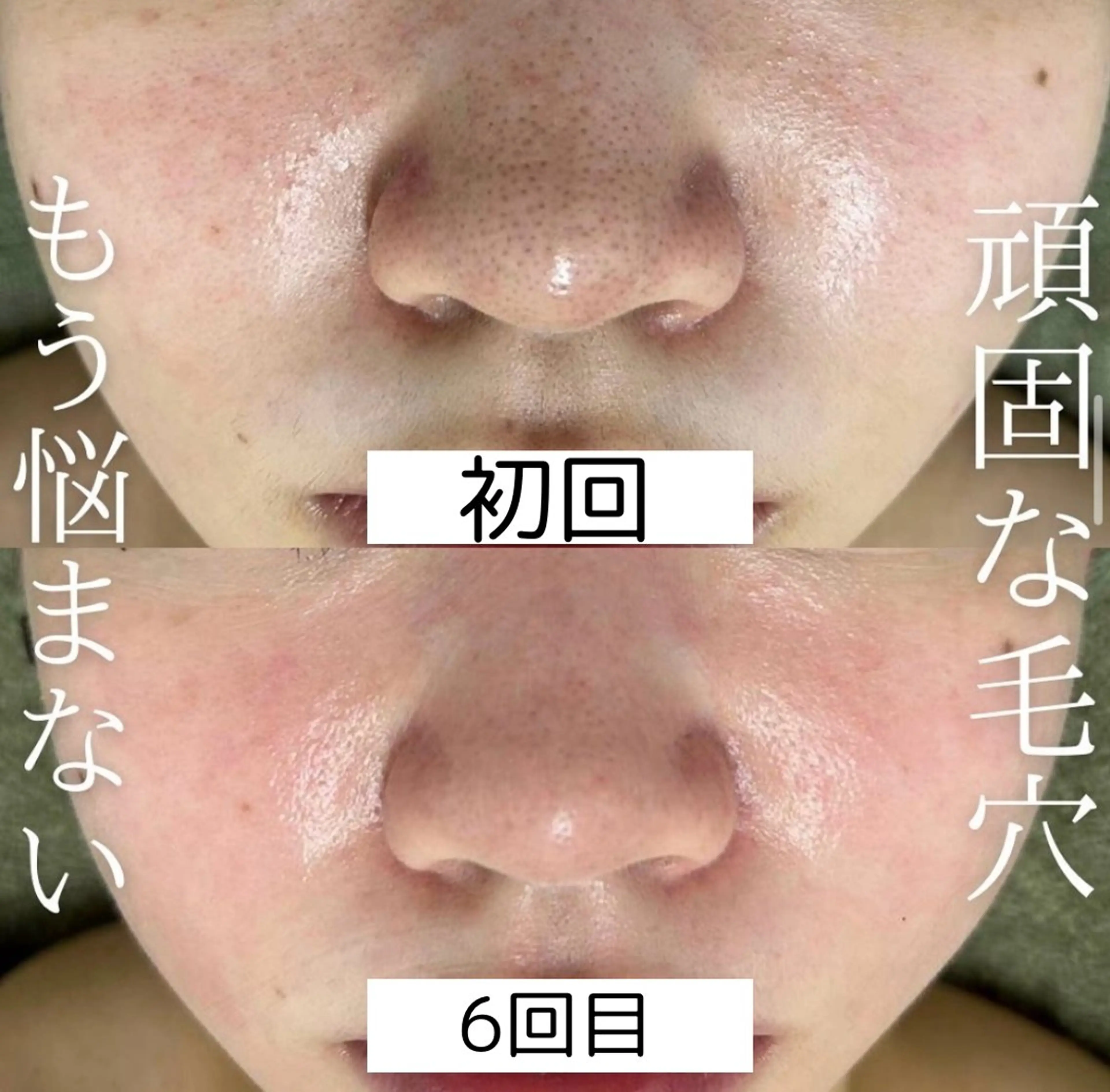 韓国美肌/肌質改善 【天神】yuiのエステ・リラクイメージ