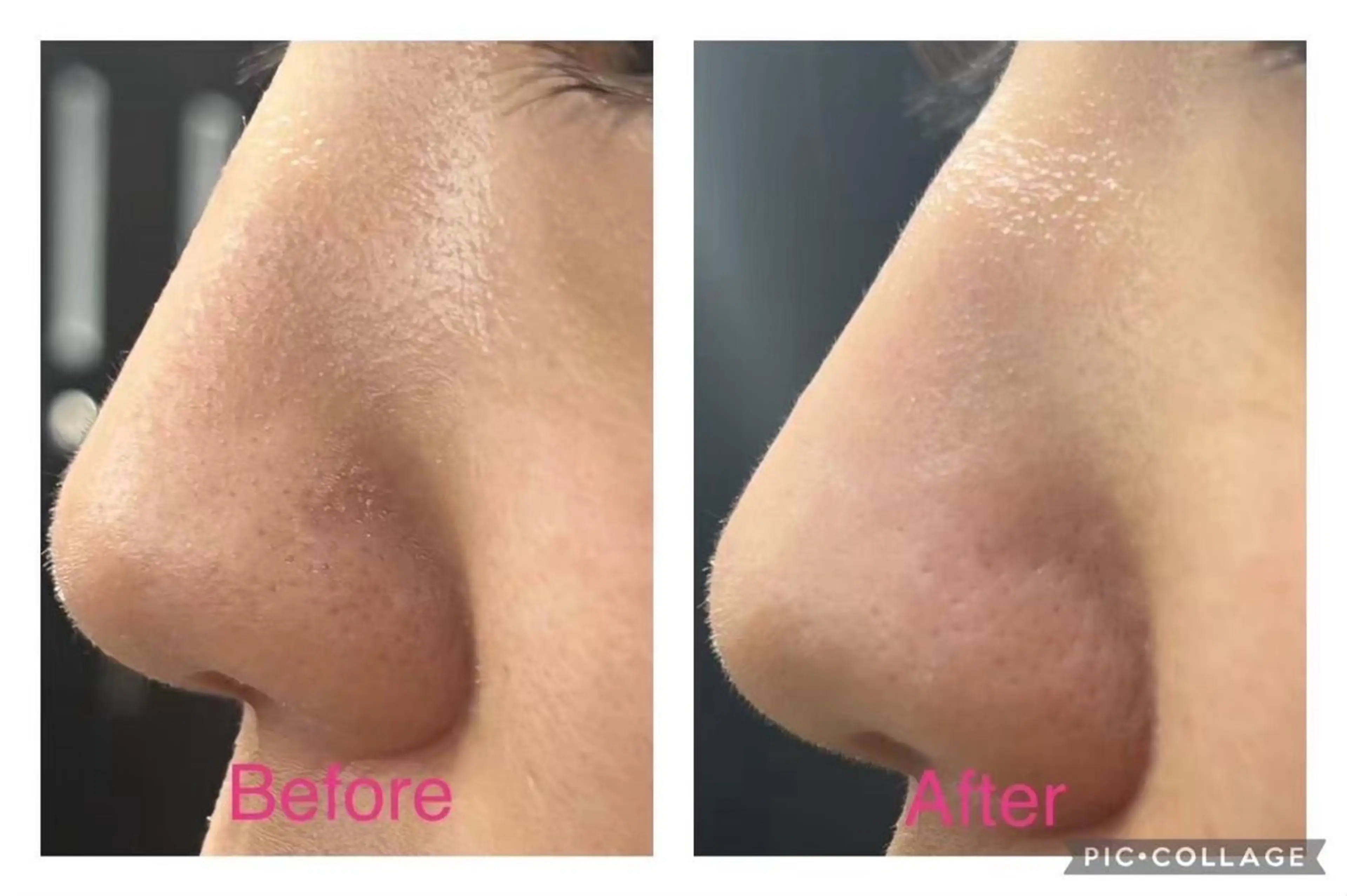 【平日限定】⚠️日時要問合せつるつる赤ちゃん肌👶水素ピーリング練習モデルさん募集中！毛穴/角質/肌質改善の写真