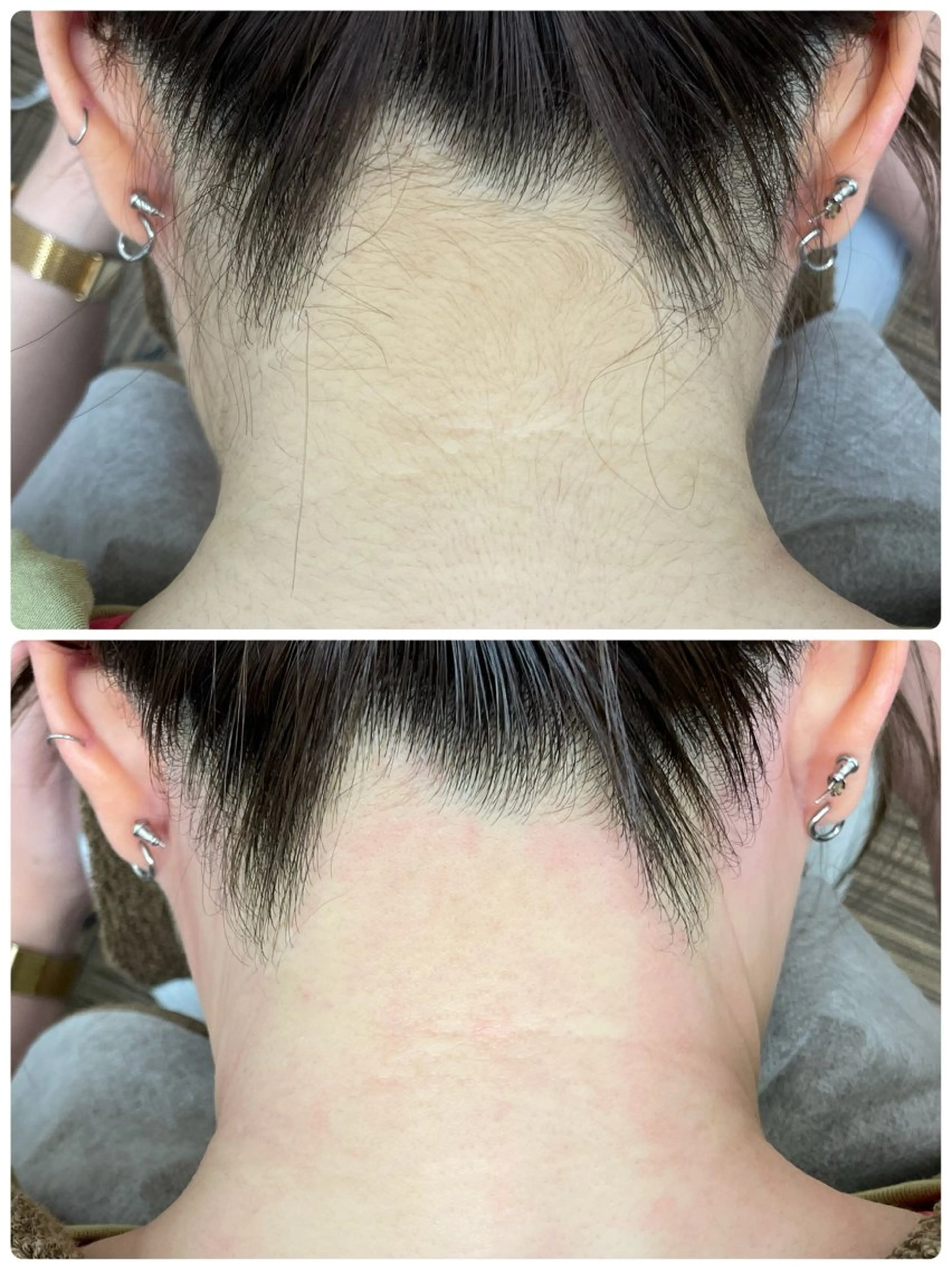 ミニモ限定💫うなじワックス脱毛の写真