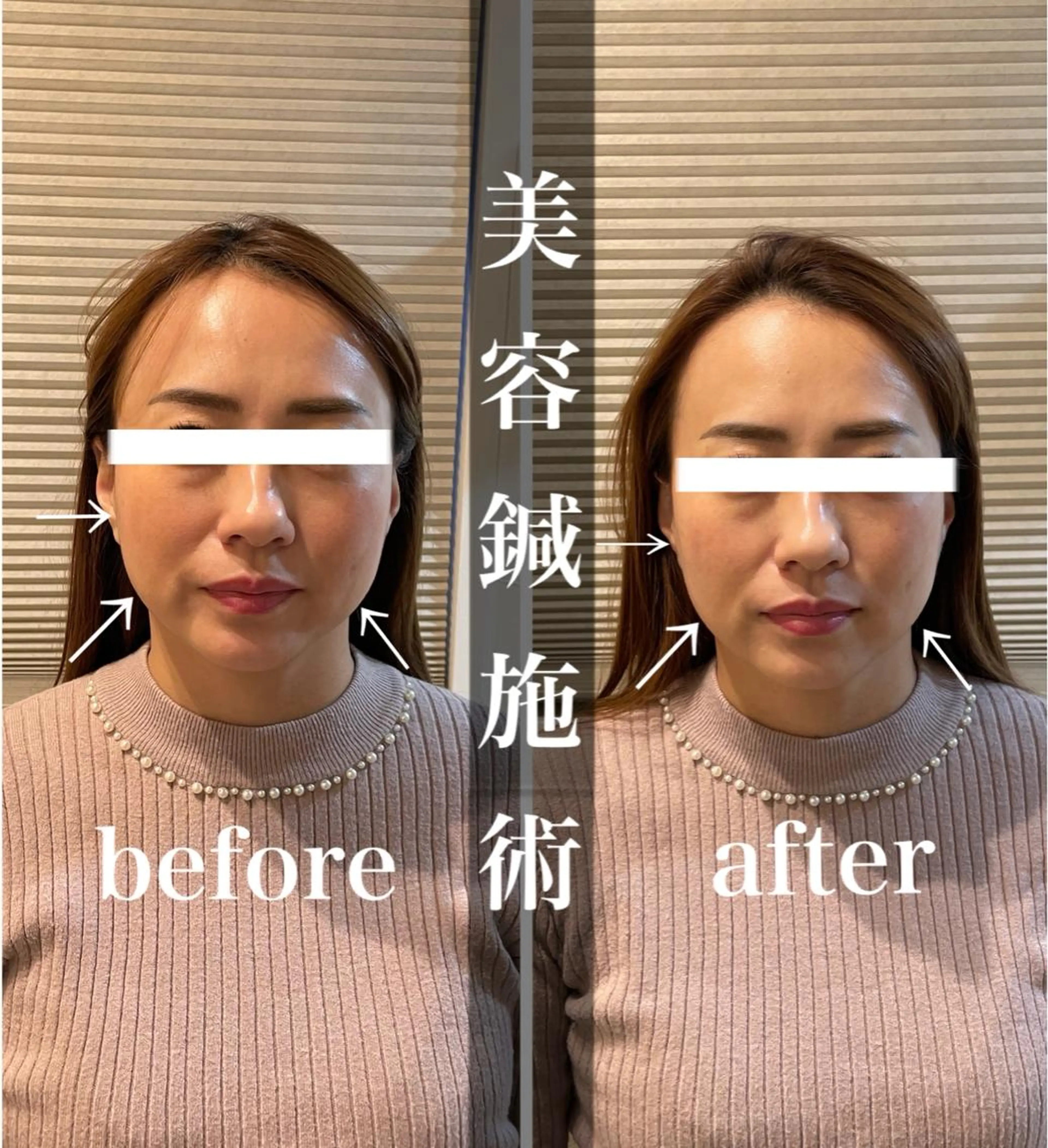 鍼灸整骨院Refine所属・鍼灸 Refineのその他イメージ