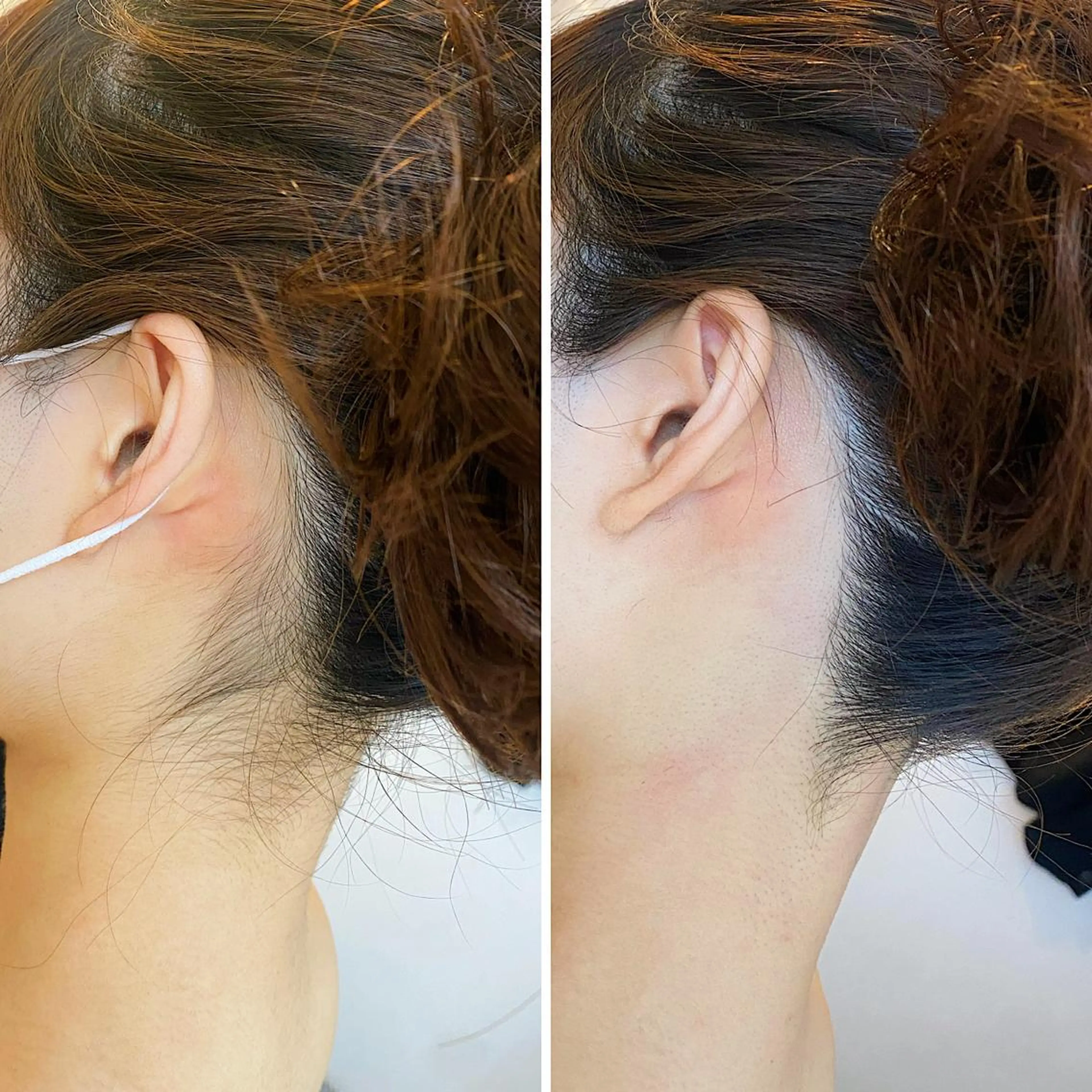 脱毛 うなじ脱毛/美肌脱毛 LABELのエステ・リラクイメージ