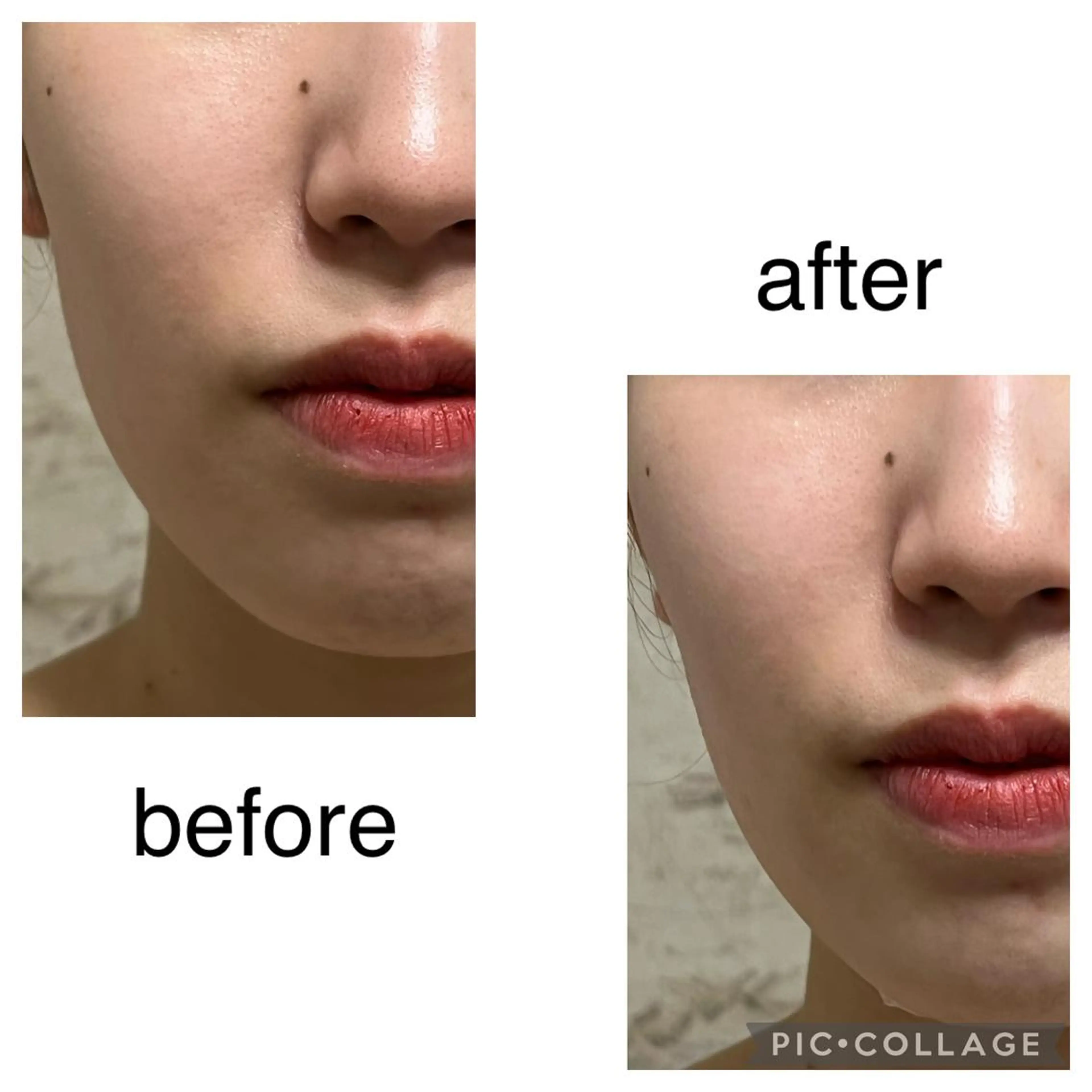 【超音波3D小顔リフトアップ/フェイスライン・頬】輪郭スッキリ！その場で実感✨の写真