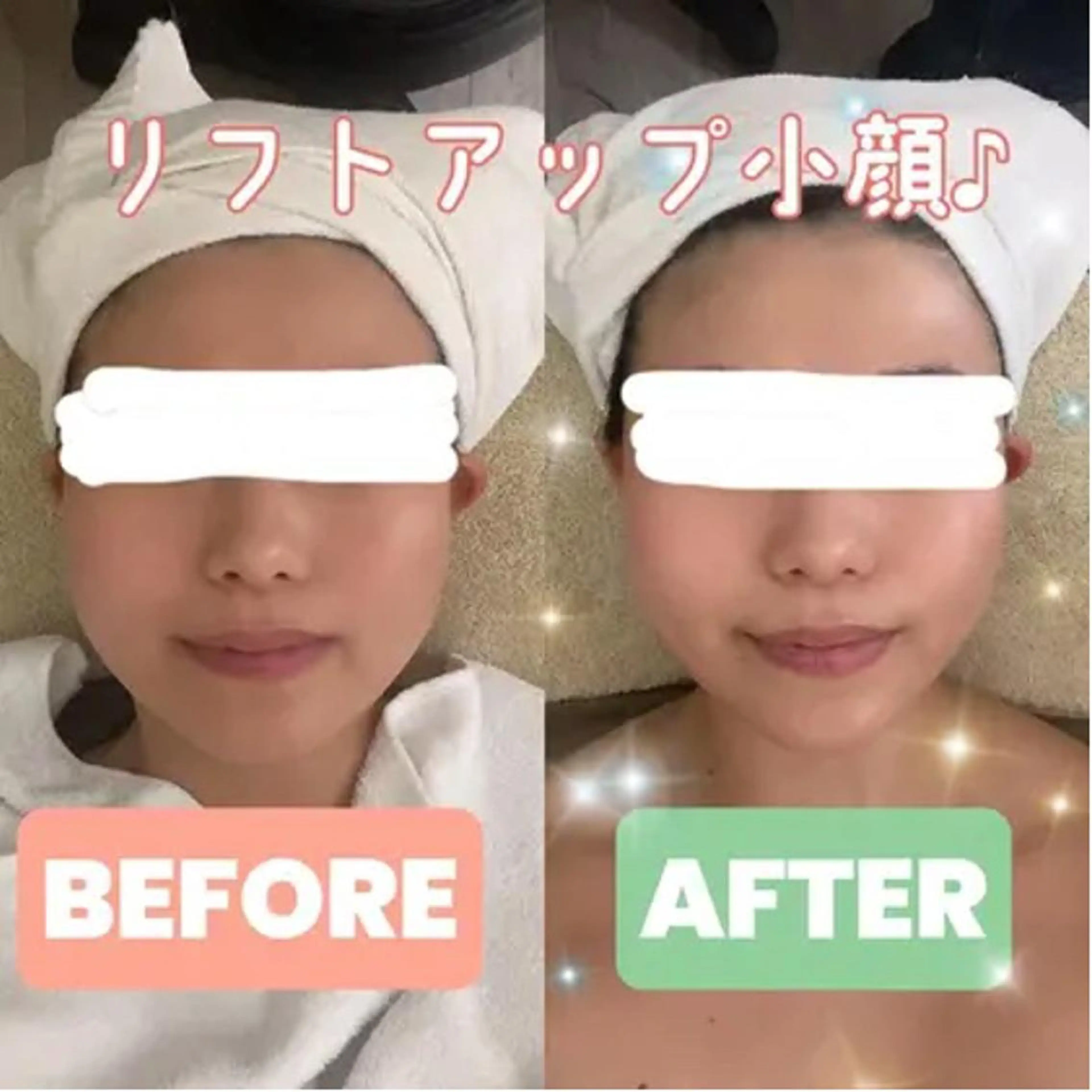 限定🌟ハイドラ・プラズマ・EMSフェイシャルから２種類の組み合わせを選べて、さらに美容液導入付きのコース☆4980円の写真