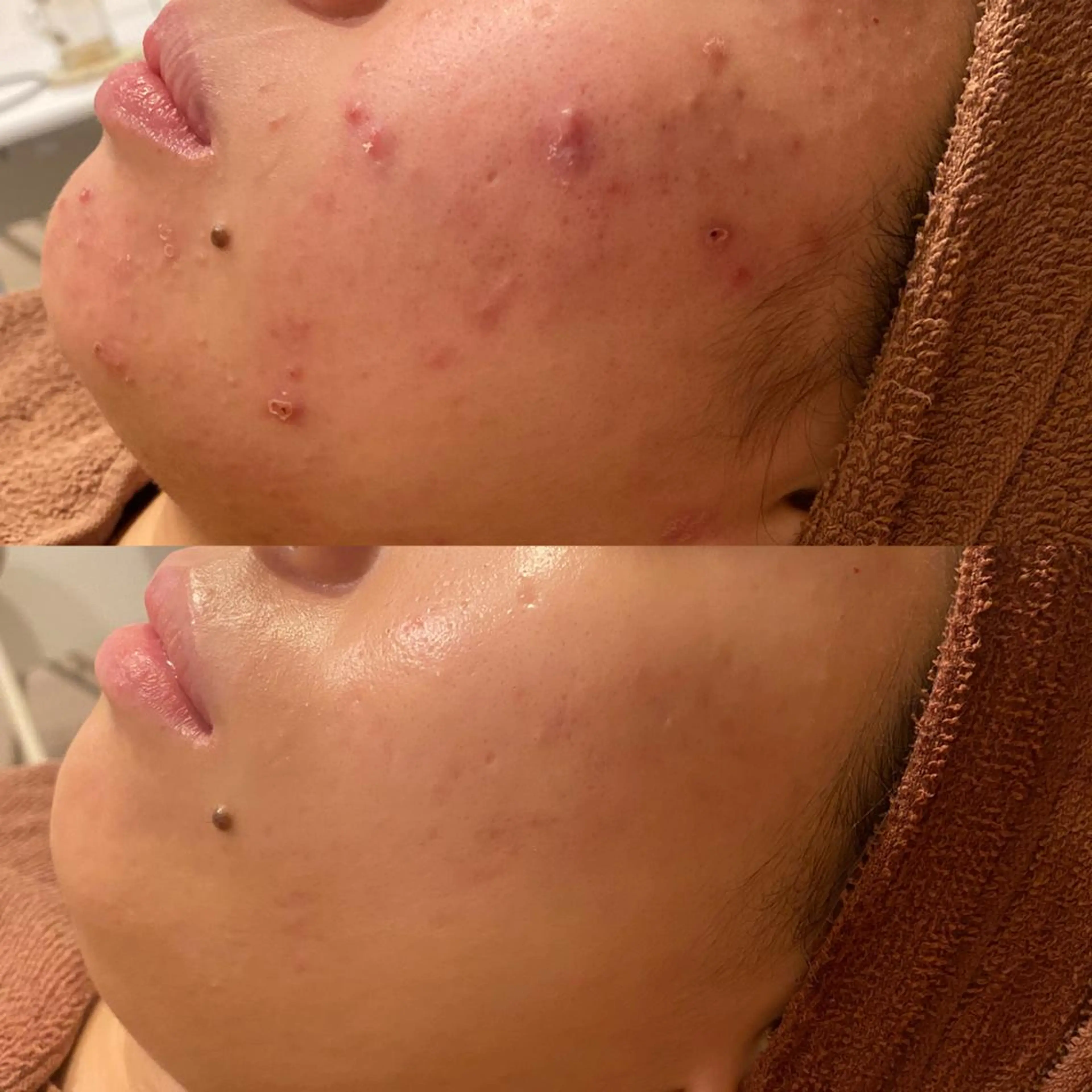 6万人の美肌実績🔥 最短ニキビ改善のエステ・リラクイメージ