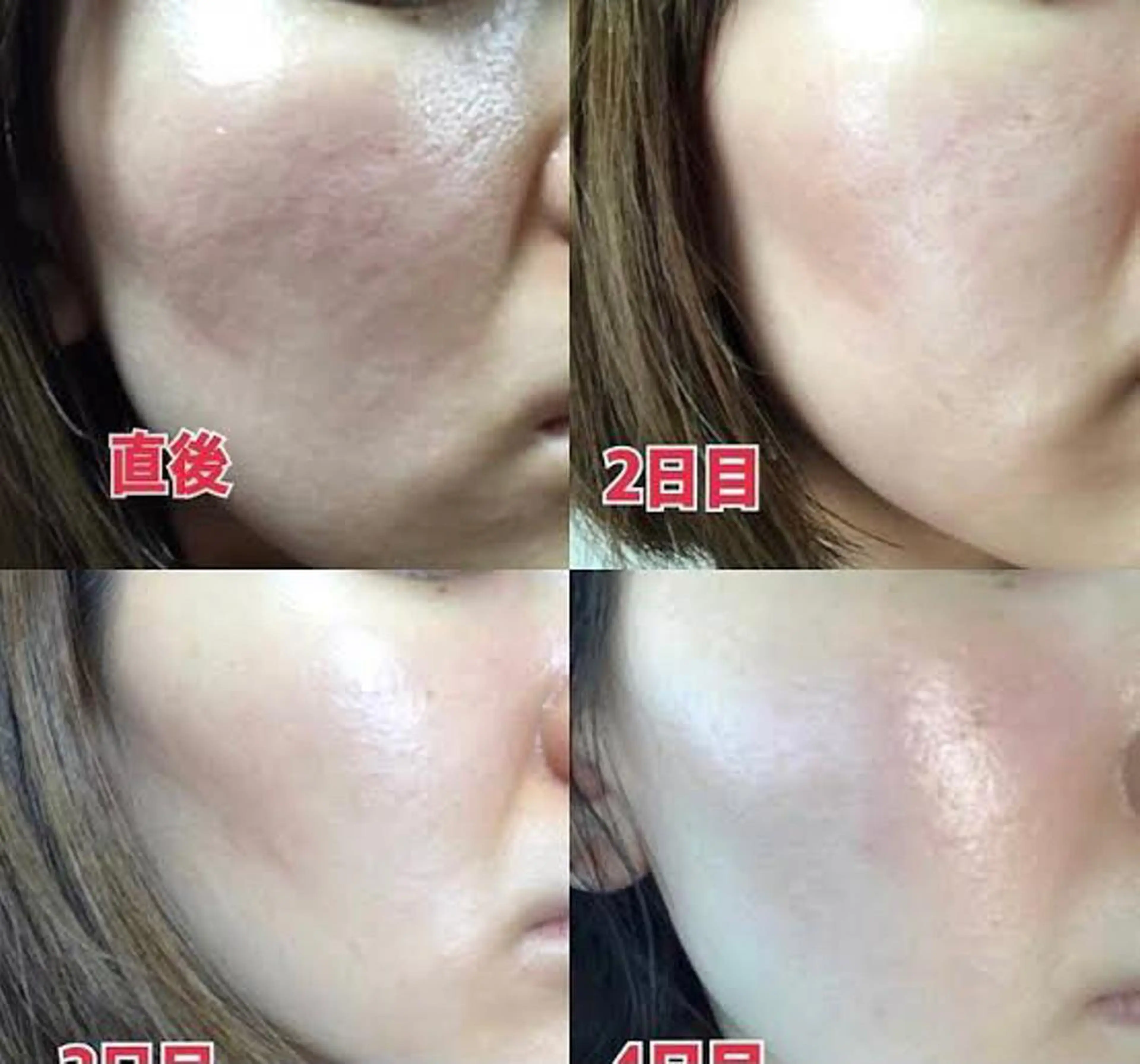 剥離しにくいソフトハーブピーリングと高濃度ビタミンCイオン導入でトラブルとさよなら毛穴レス肌を手に入れよう❤️の写真