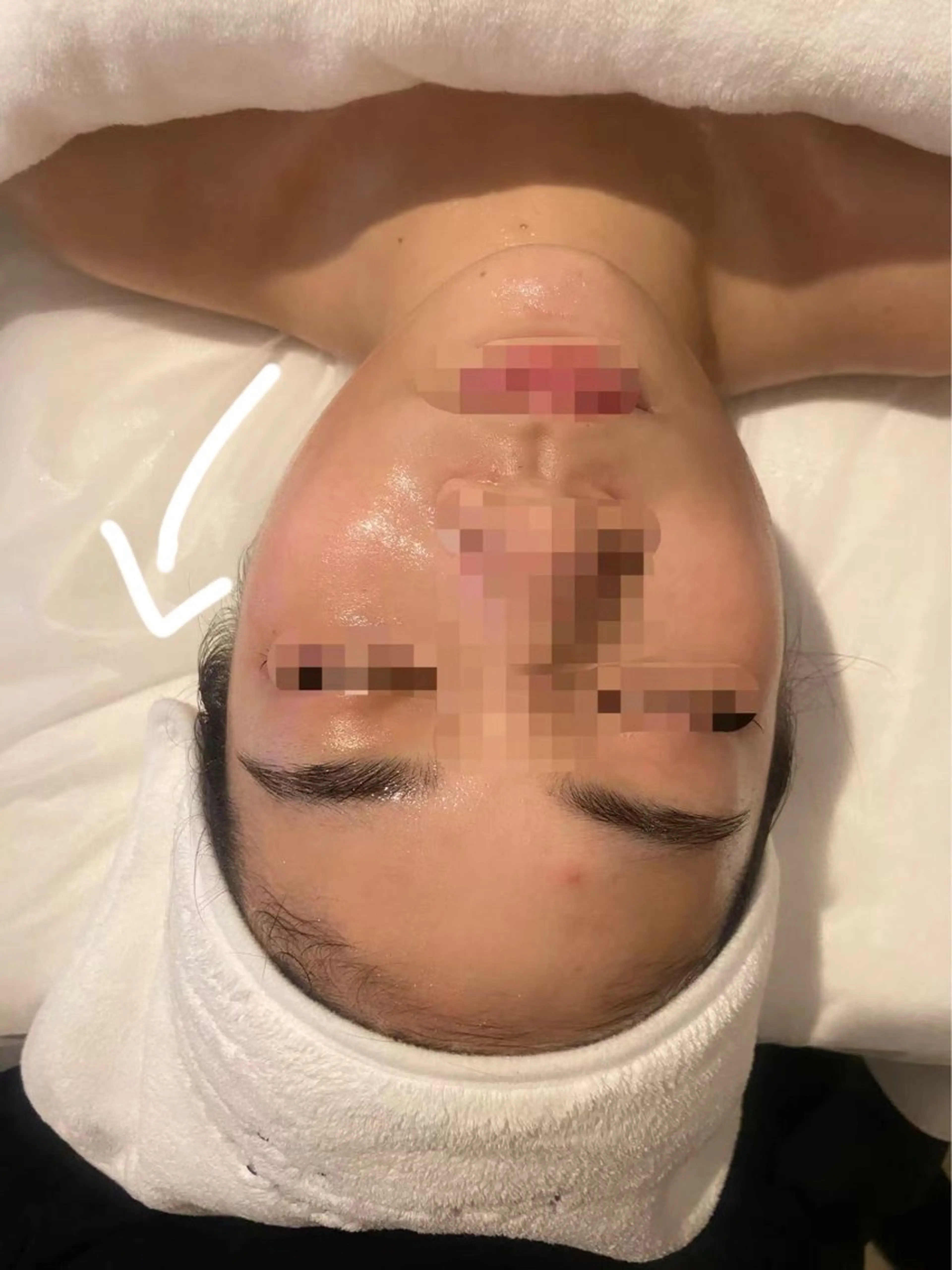 [人気NO.1小顔＆リフトアップ]ハイパーナイフ小顔+コルギ+石膏パック90分の写真