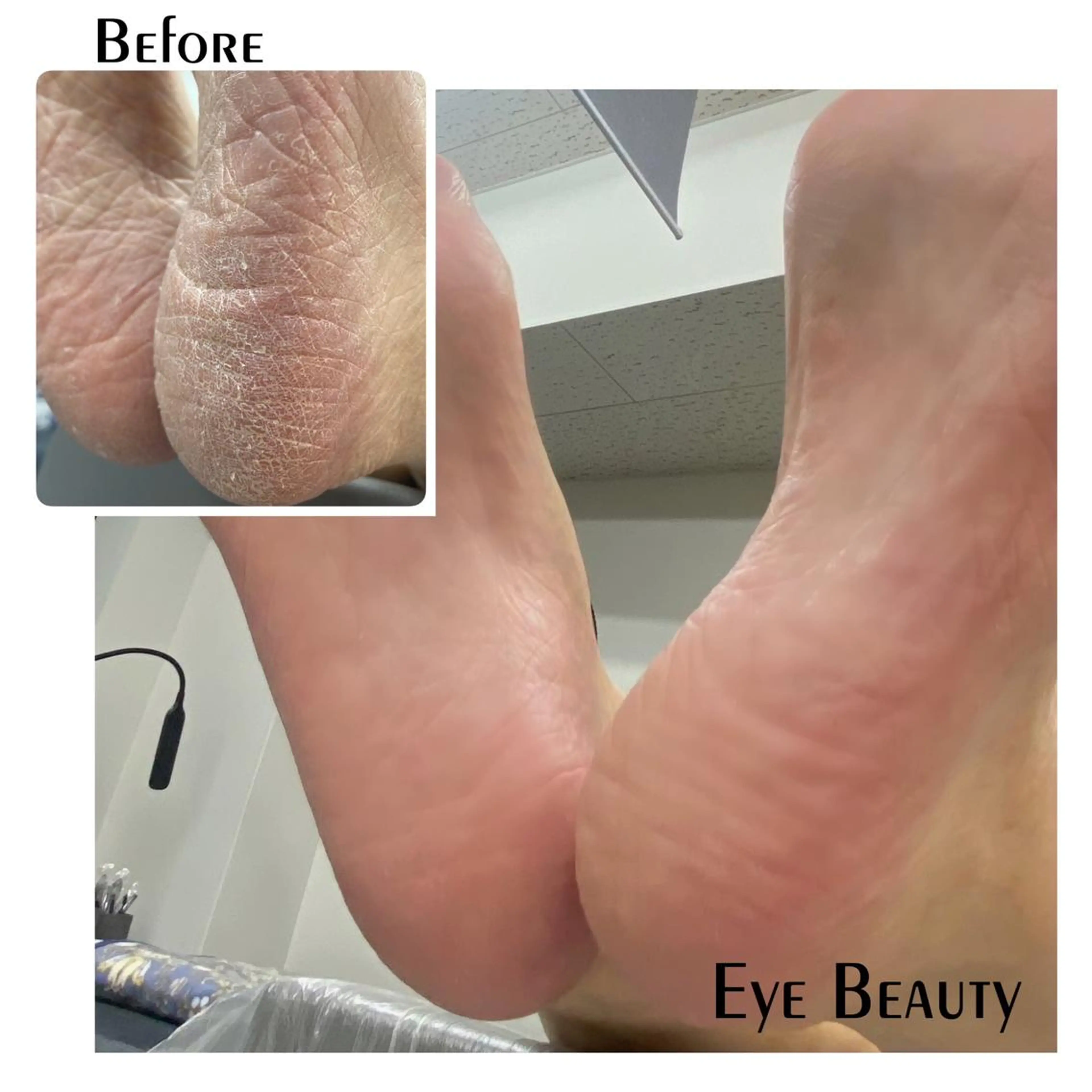 パティプランニング(足🦶角質ケーア)¥7800現金のみです。よろしくお願いします。の写真