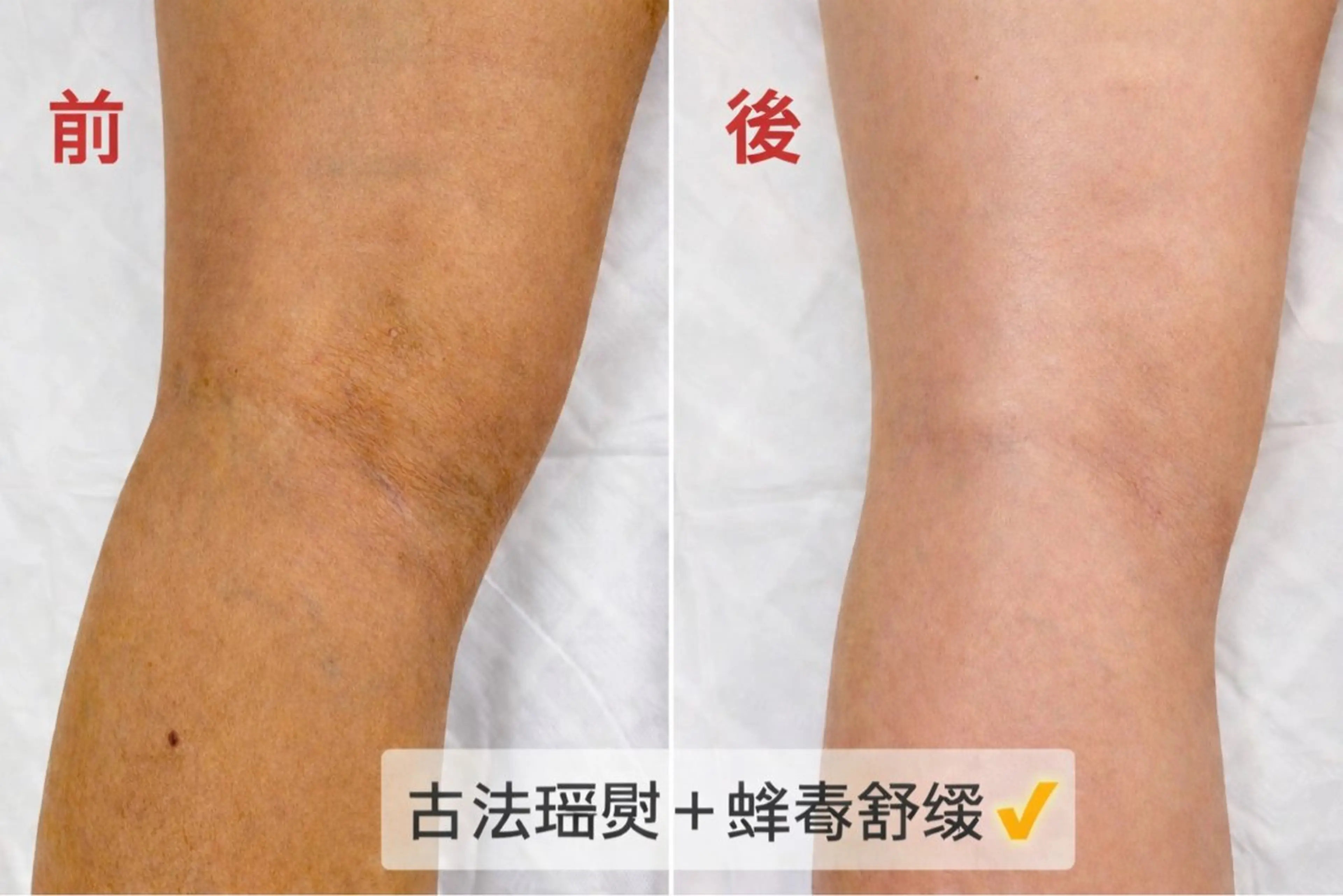 漢方古法瑶熨 脚部 50分 ＋ 蜂毒オイル循環ケア 50分1回の写真