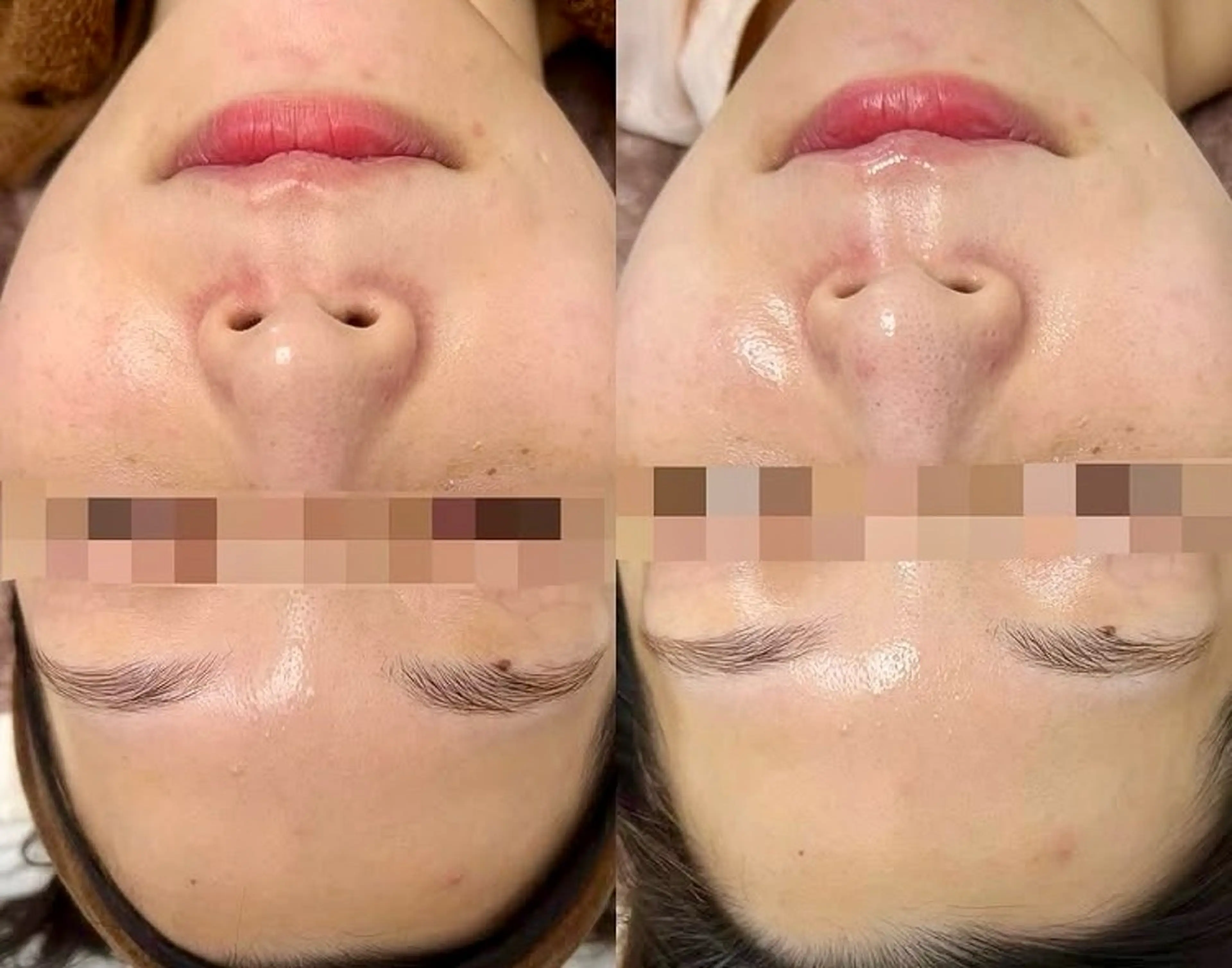 【最新機種アクアダーマ✖️美白】艶・透明感のある美肌ケアに🫥✨の写真