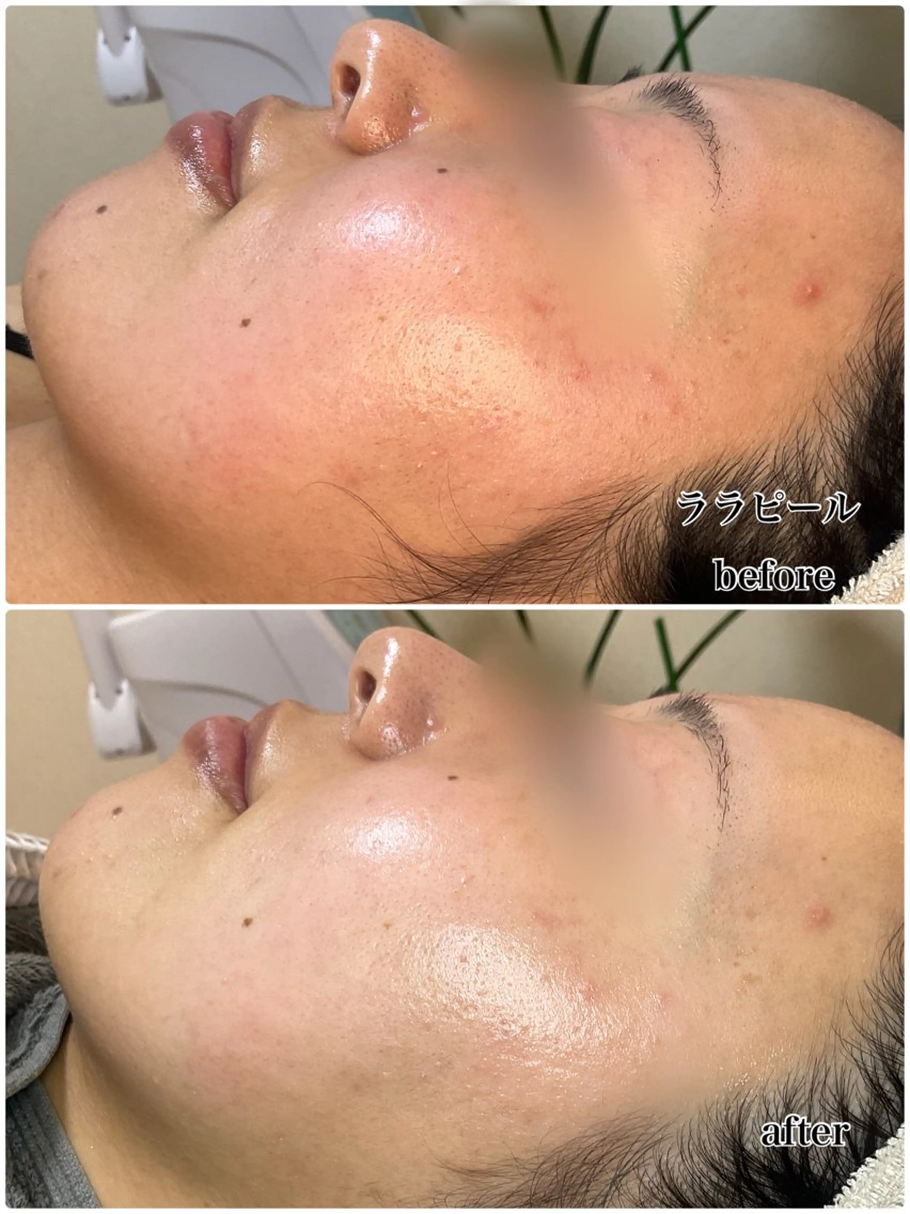 🇰🇷韓国女優級ツヤ肌✨ララピール｜山梨最安値💎クチコミ必須｜NMN贅沢マスク付🧬の写真