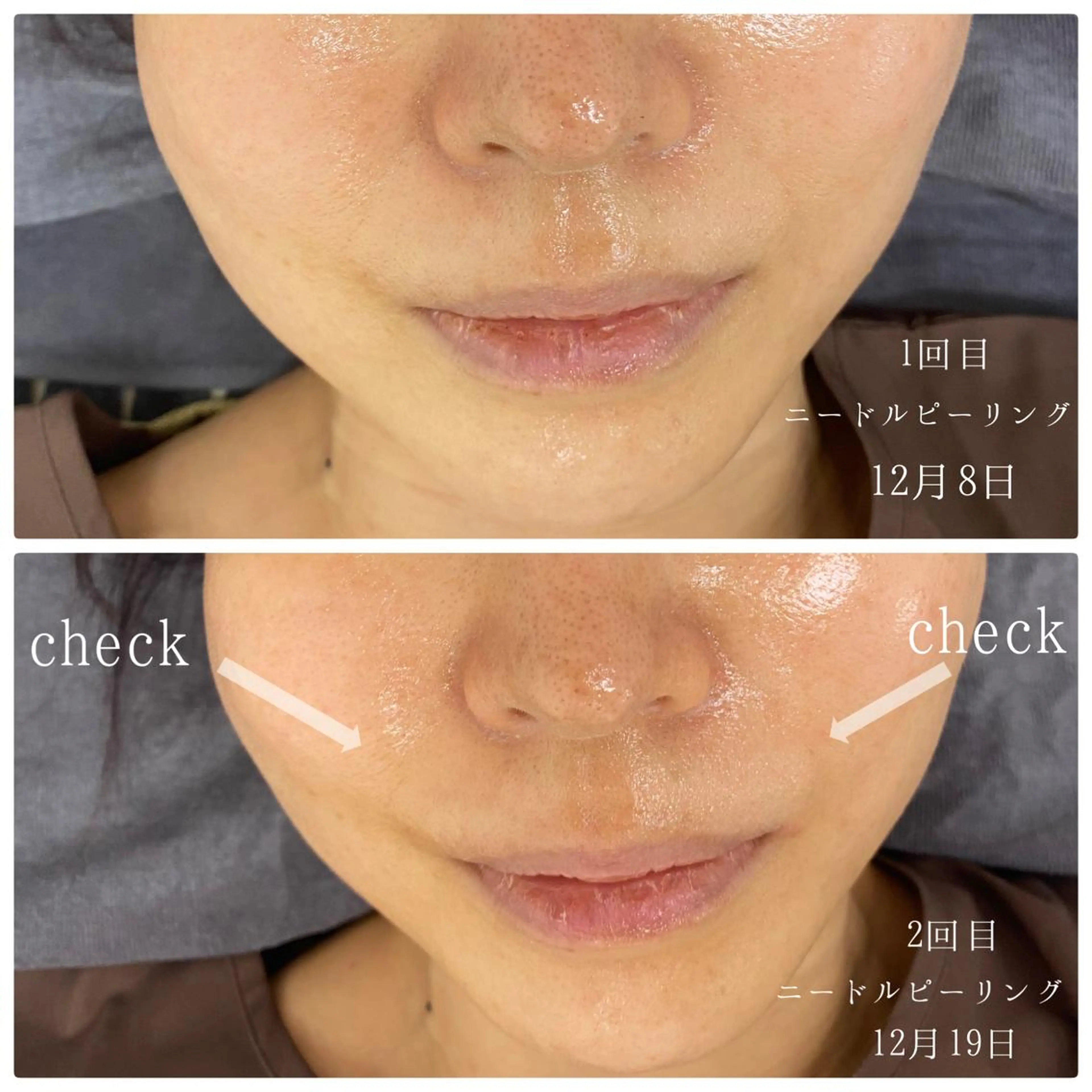 ニキビ特化美容鍼 ×ハーブピーリングのエステ・リラクイメージ