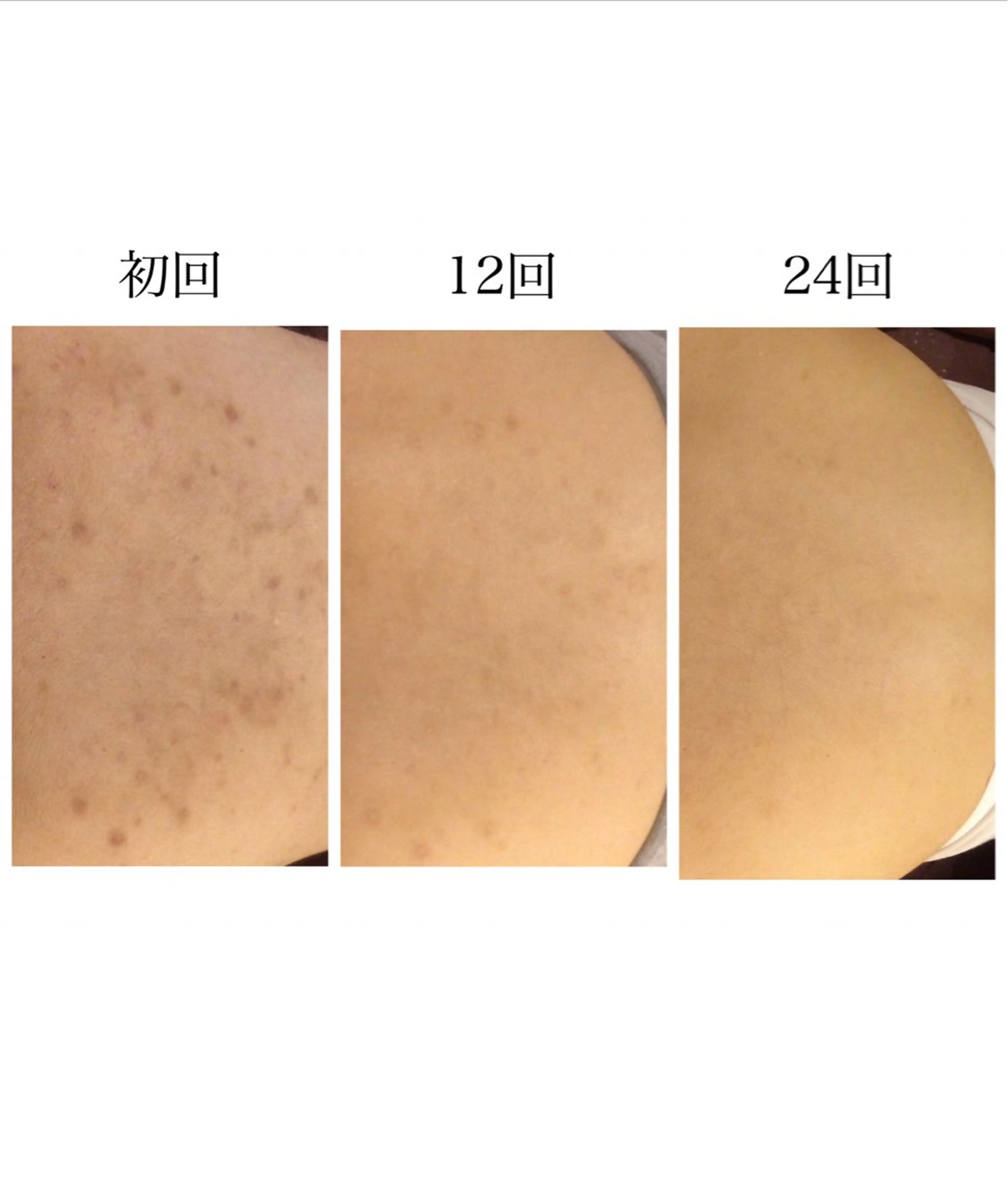 エステ リラク 夏までに肌荒れ卒業 するサロン🌻のエステ・リラクイメージ