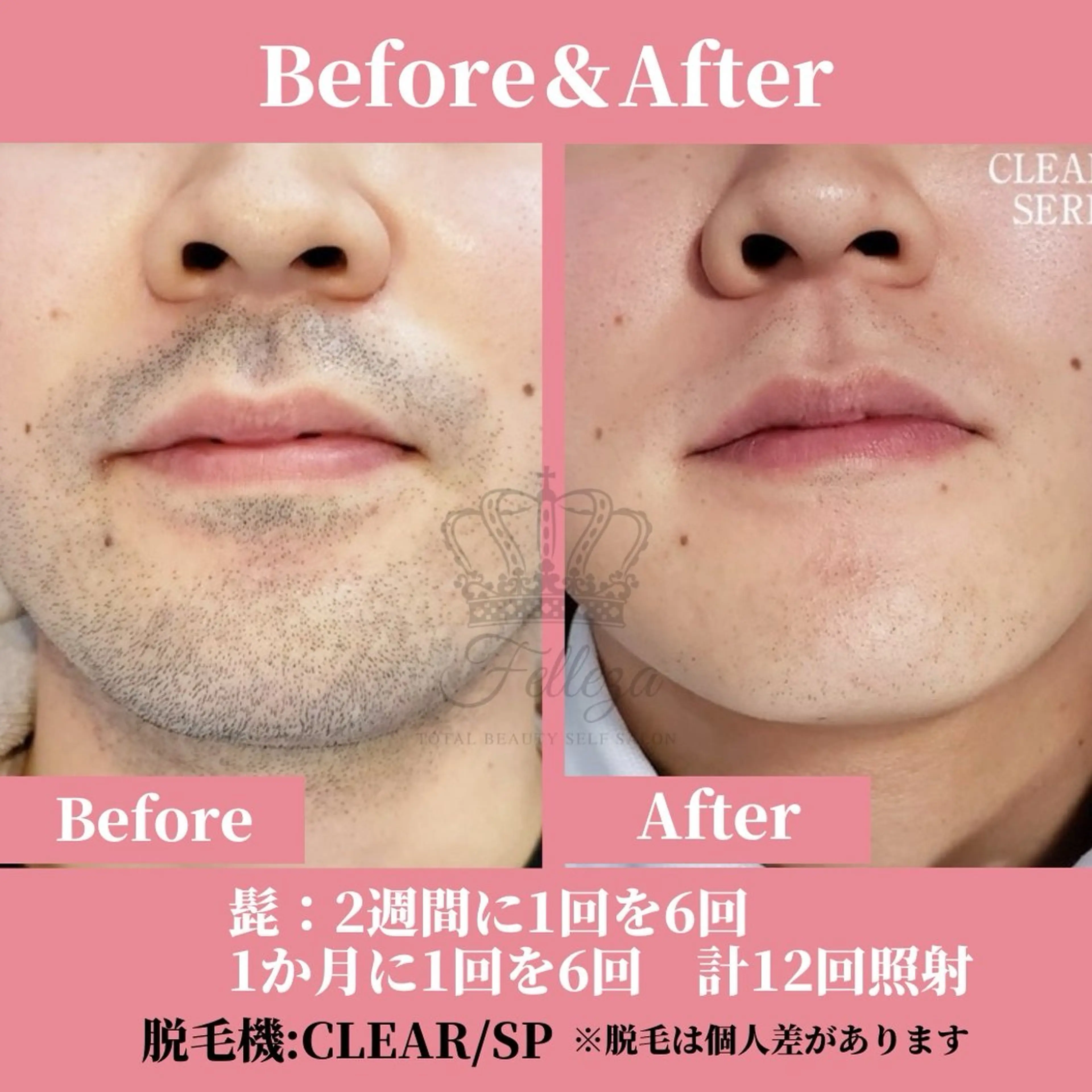 メンズ 有人型セルフサロン 脱毛/痩身/美顔のその他イメージ