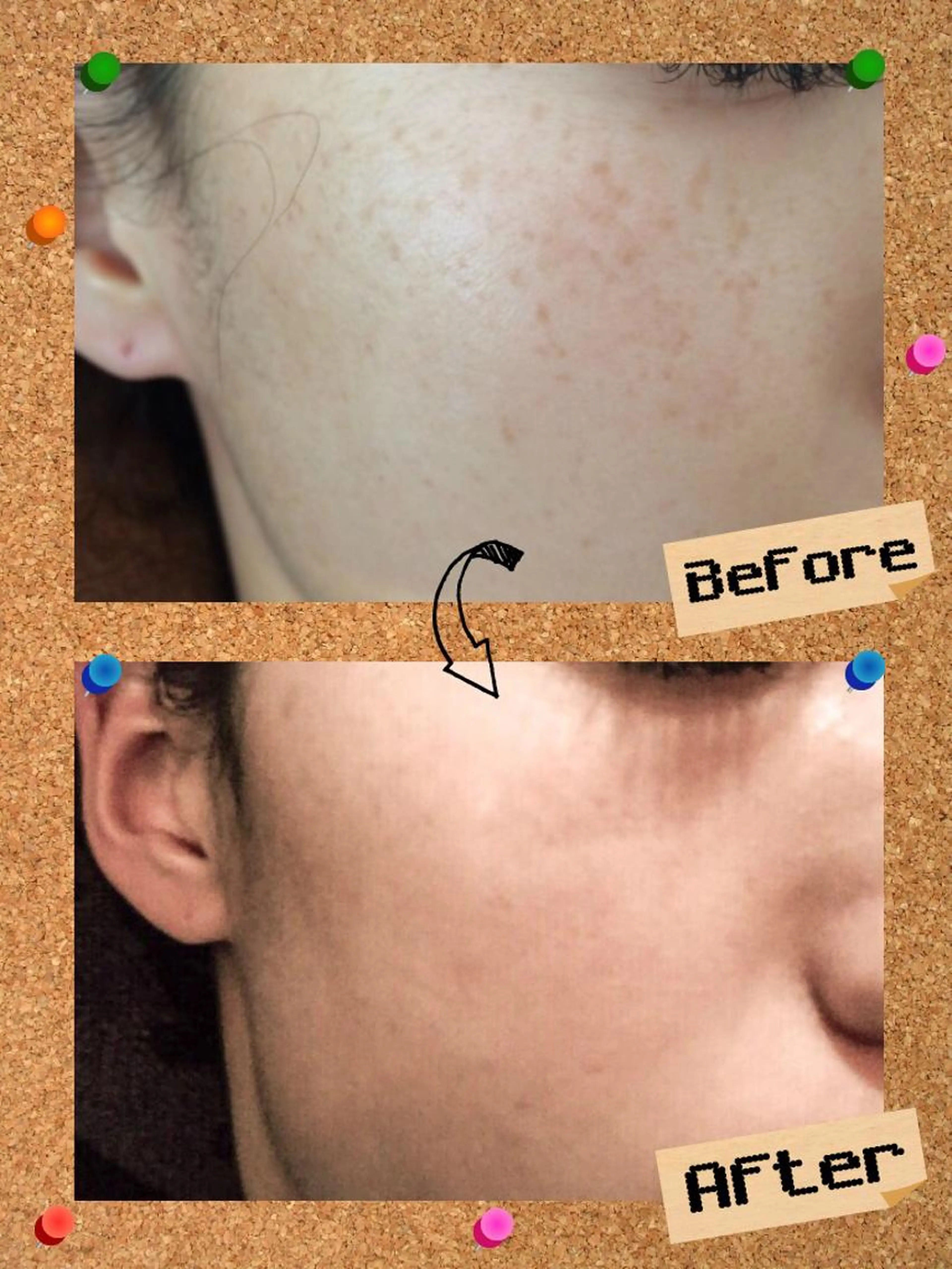 イチオシ【ご新規様限定】シミ撃退！！夏でも出来るレーザーではないシミケア‼️60ショットの写真