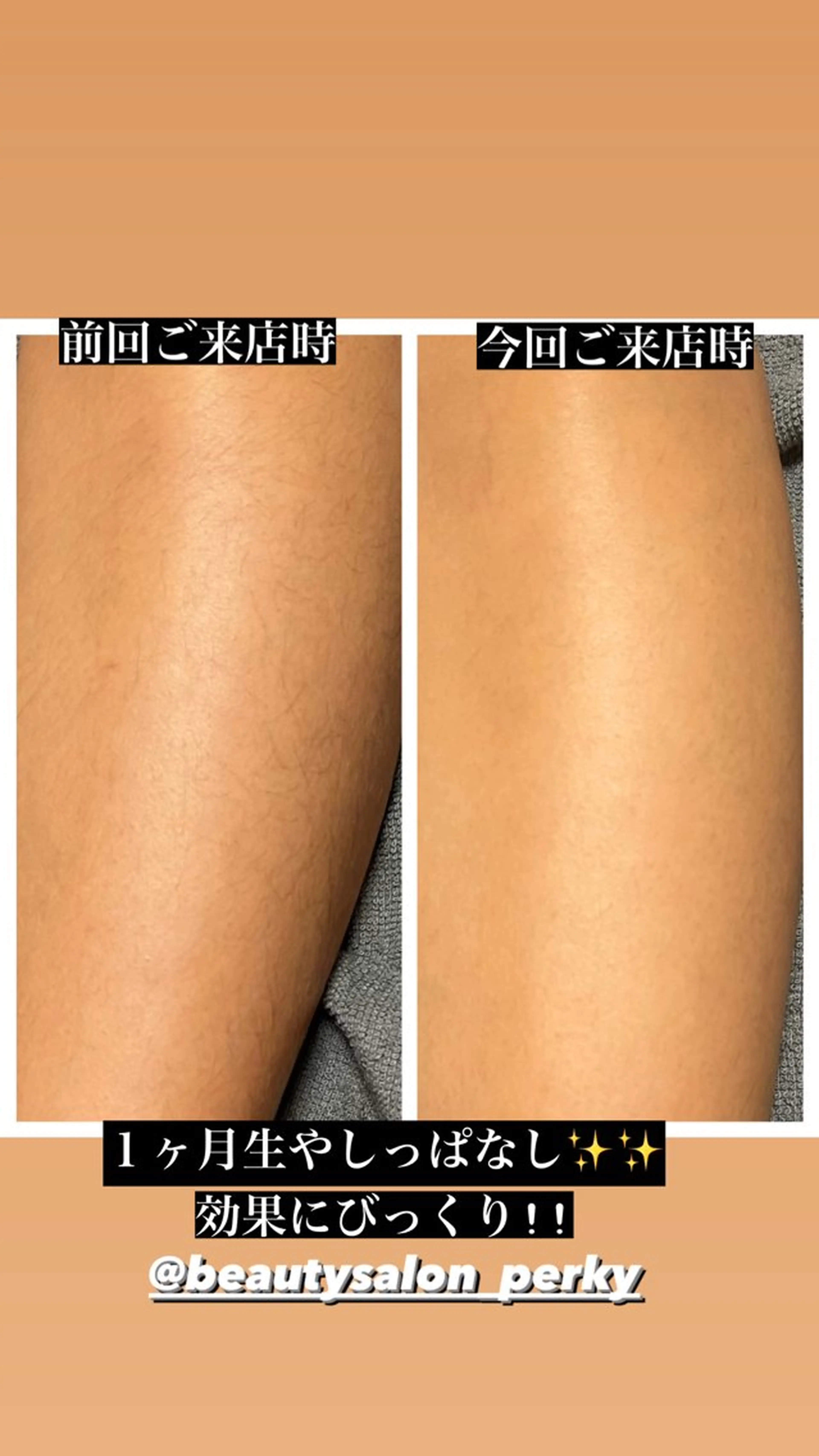 woman 全身脱毛(顔・vio込)の写真