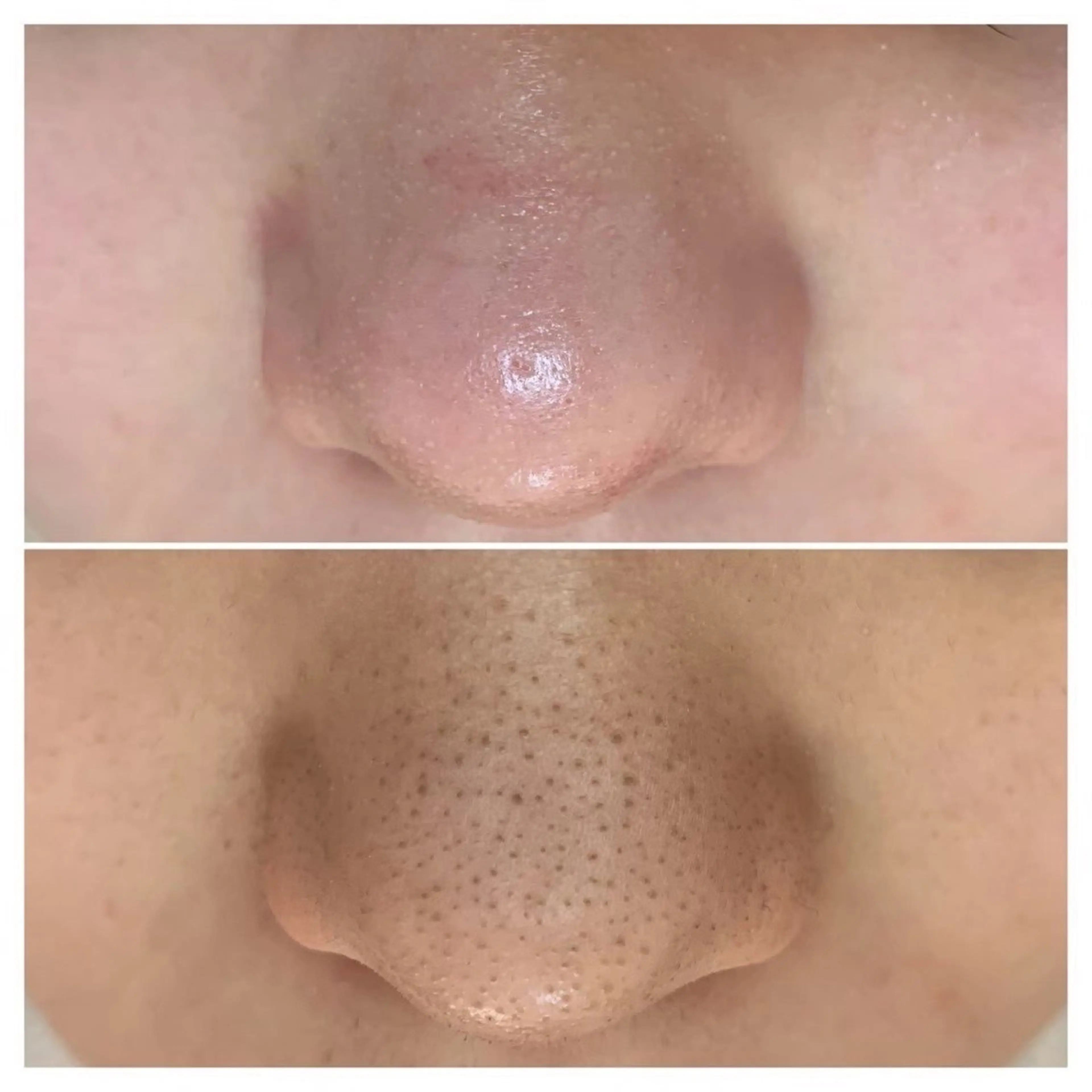 毛穴洗浄🫧高保湿リフトマスク付き¥12,100→6,600の写真