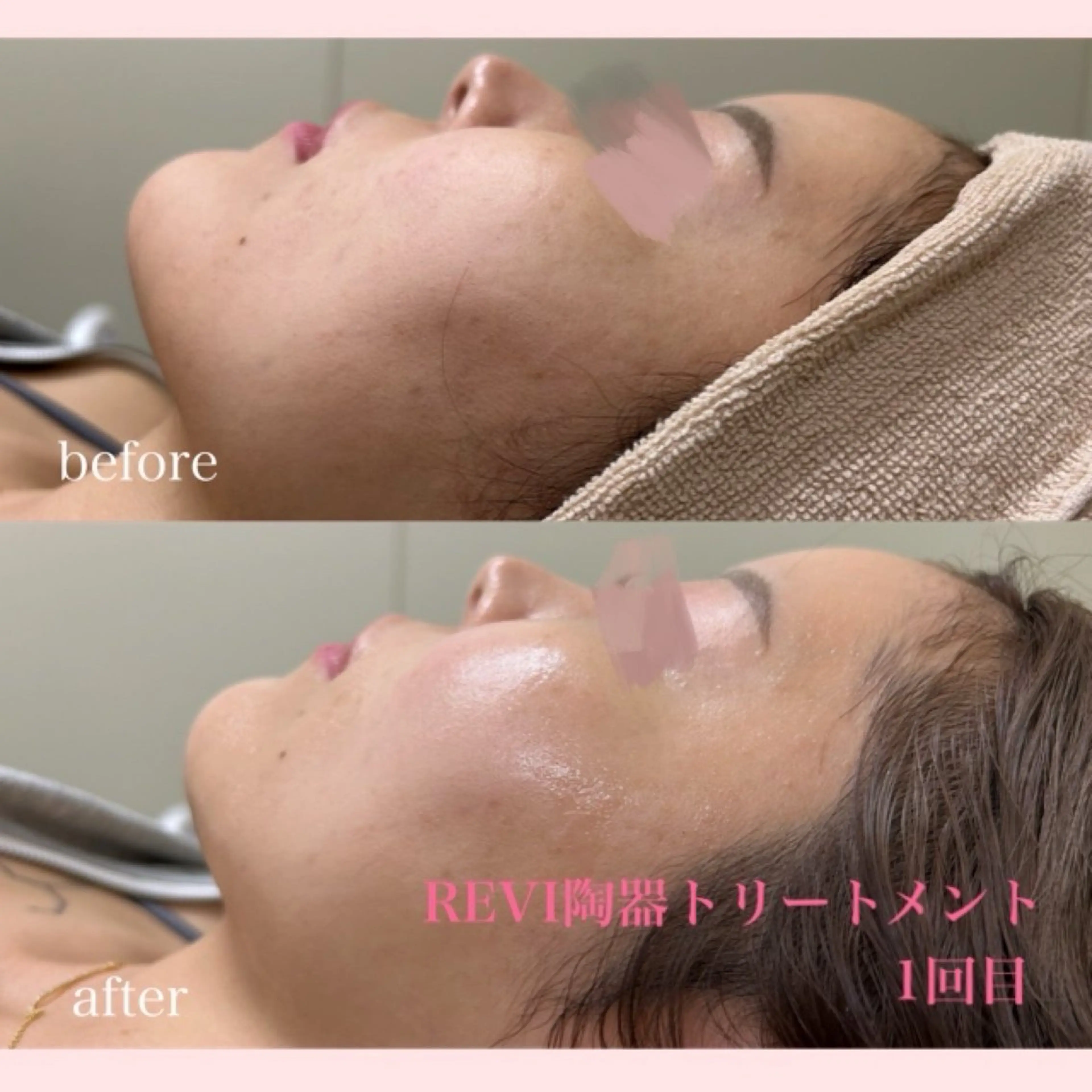 エステ 美容サロンAkazukin所属・REVI認定脱毛サ ロンAkazukinのエステ・リラクイメージ