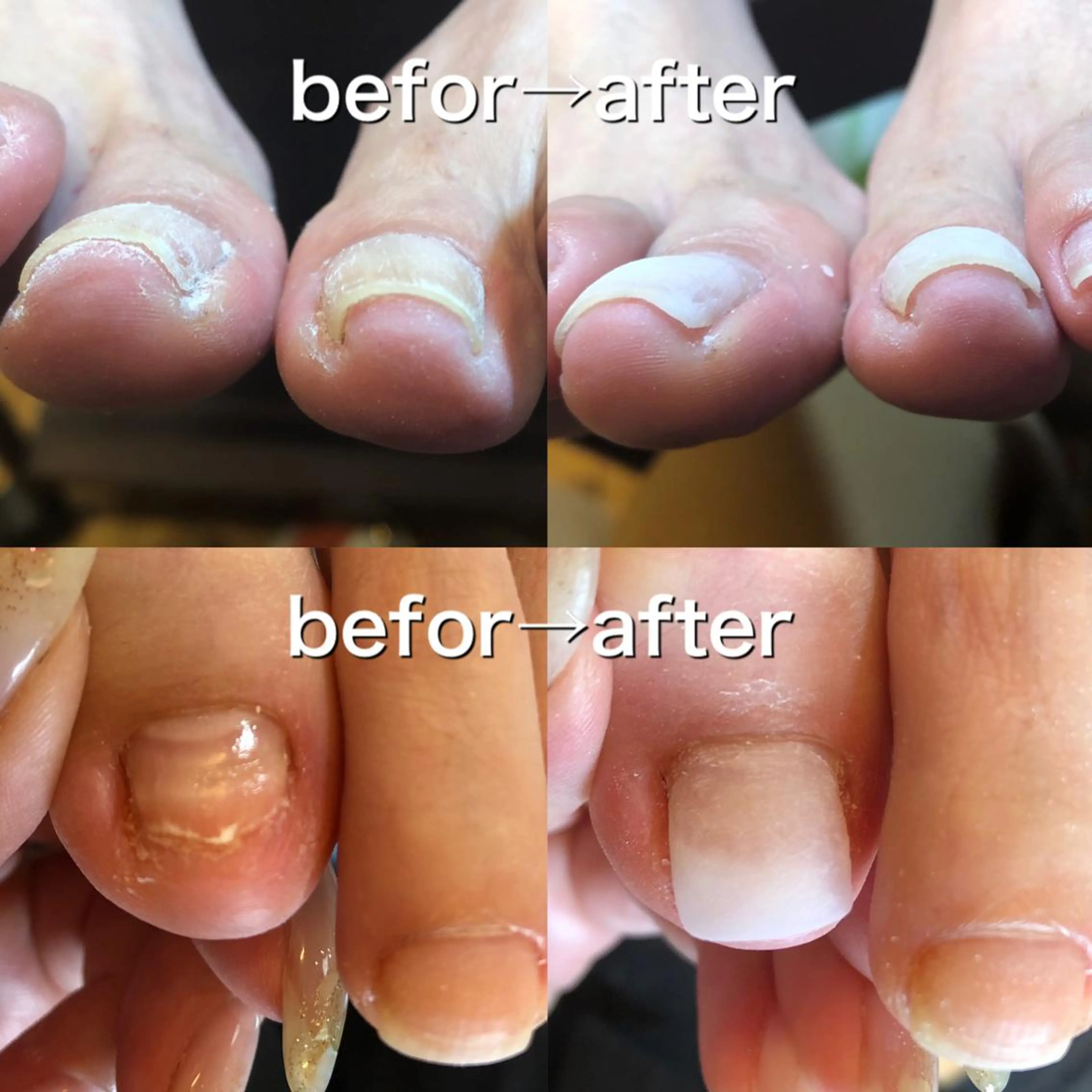 巻き爪や切りすぎたお爪にお悩みの方へ！フット特殊補強(1本)の写真