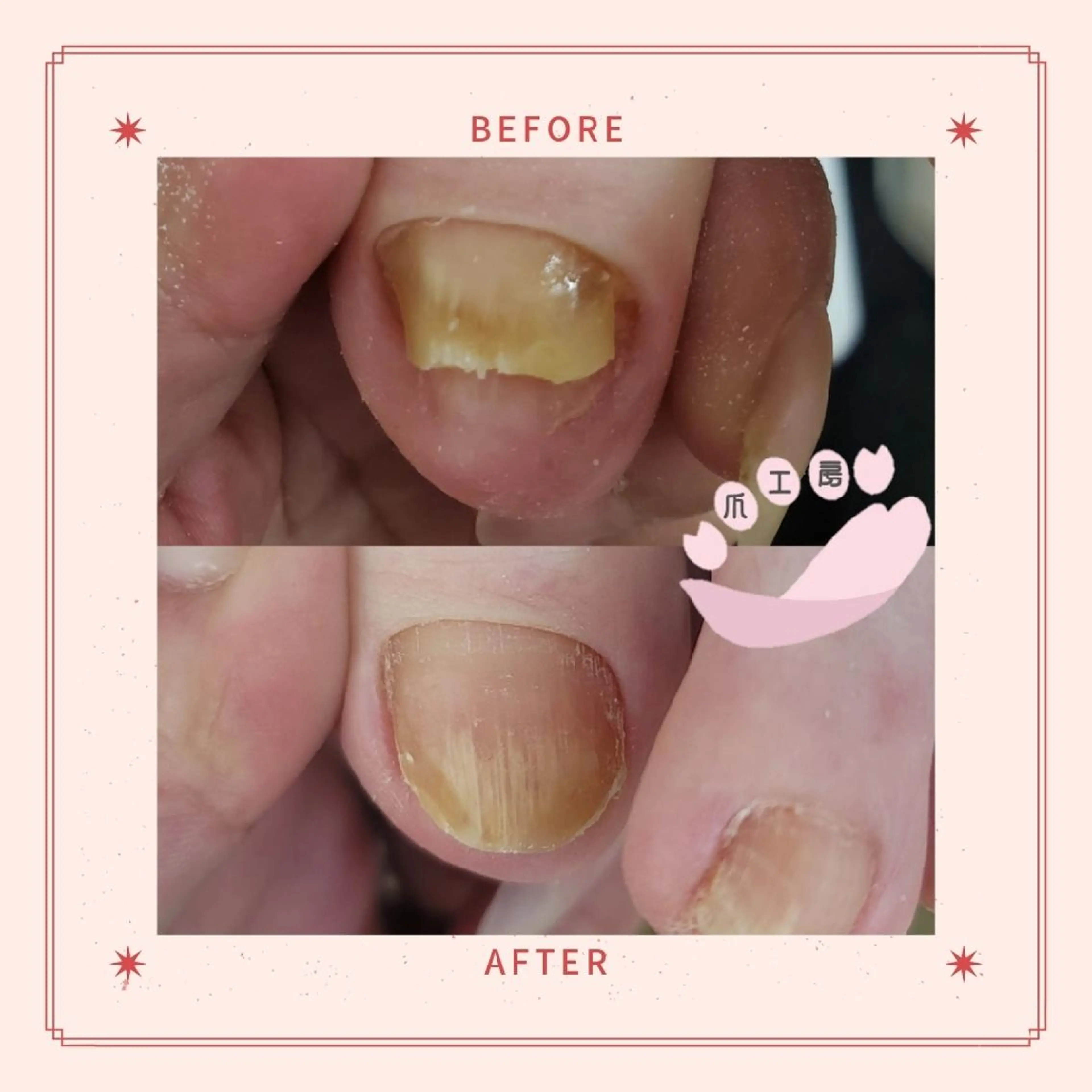 伸びない爪ケアの写真